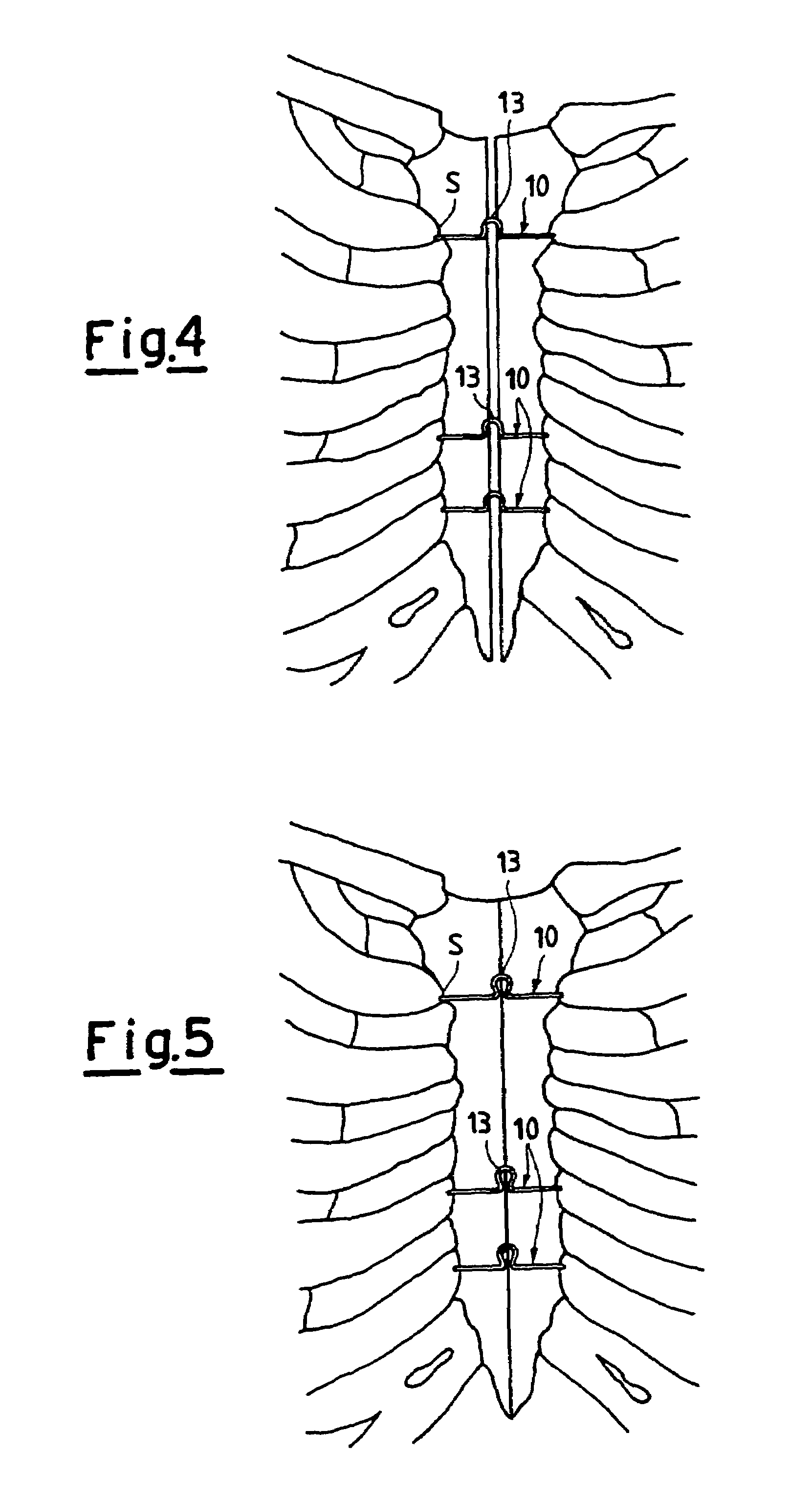 Semi-rigid compressive clamp for use in sternotomy, and forceps for its application