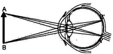 A Calculation Method of Diopter of Intraocular Lens