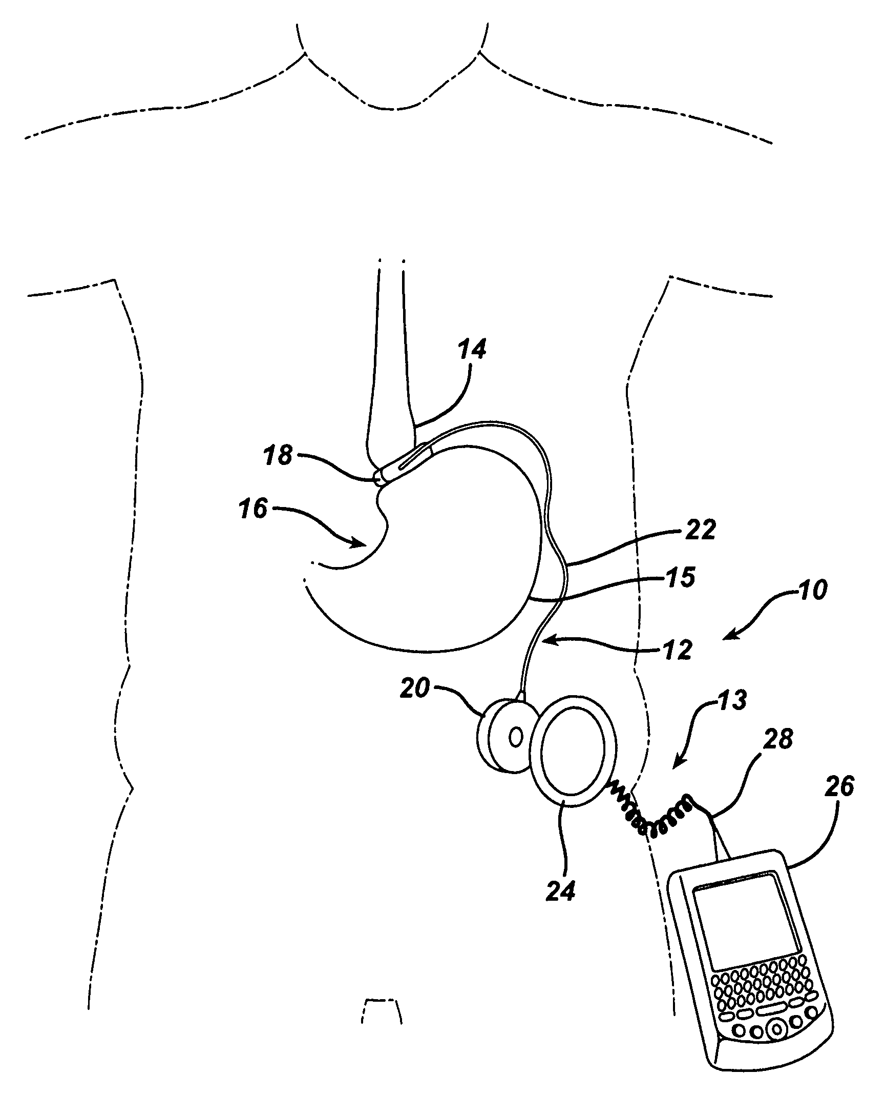 Metal bellows position feedback for hydraulic control of an adjustable gastric band