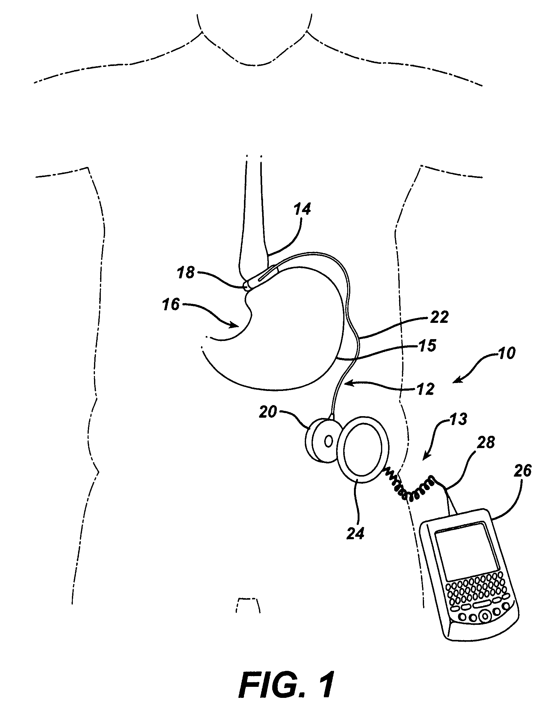 Metal bellows position feedback for hydraulic control of an adjustable gastric band