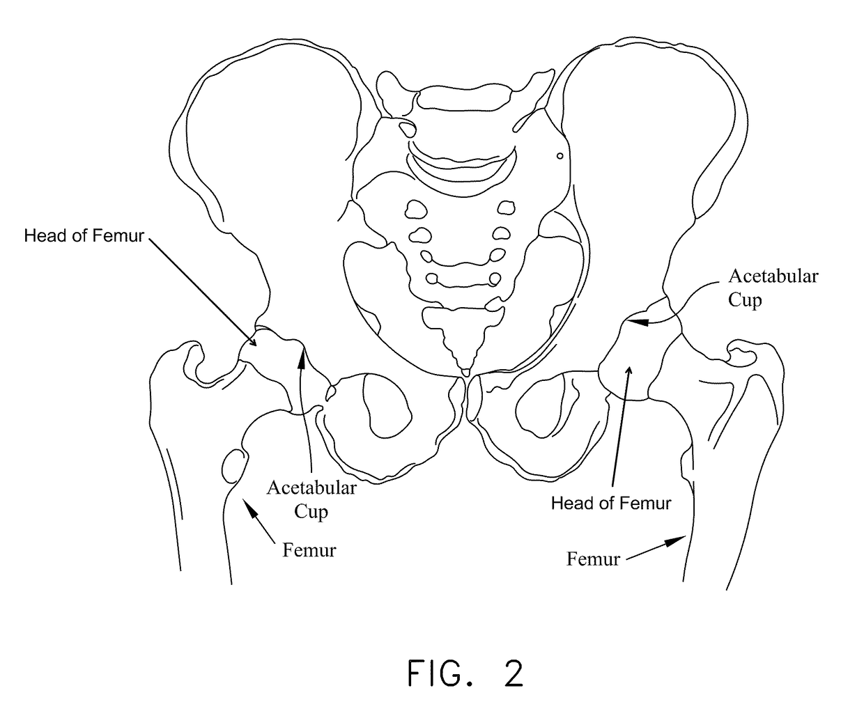 Method and apparatus for treating a hip joint, including the provision and use of a novel suture passer