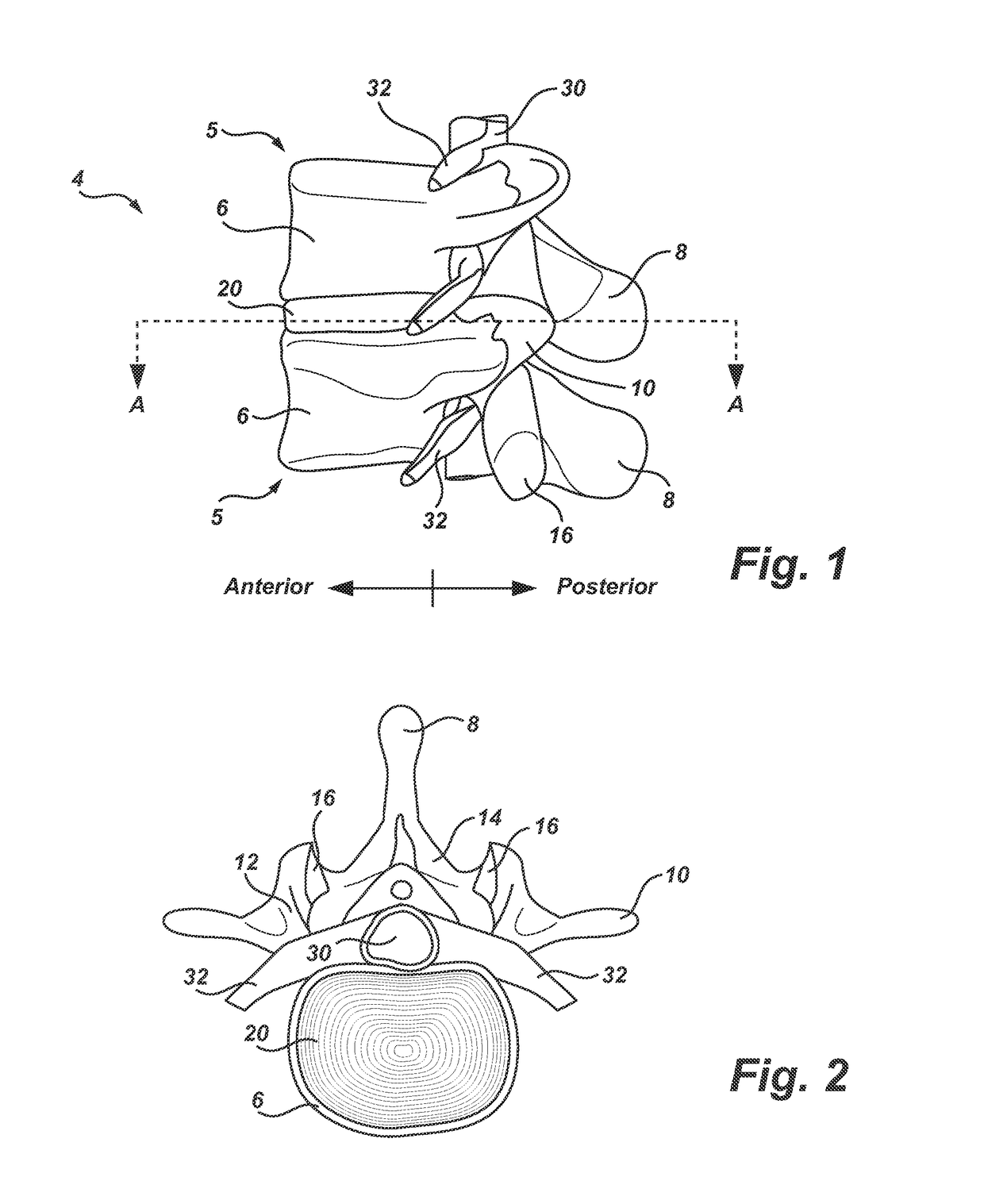 Systems and Methods for Patient-Specific Total Disc Replacement