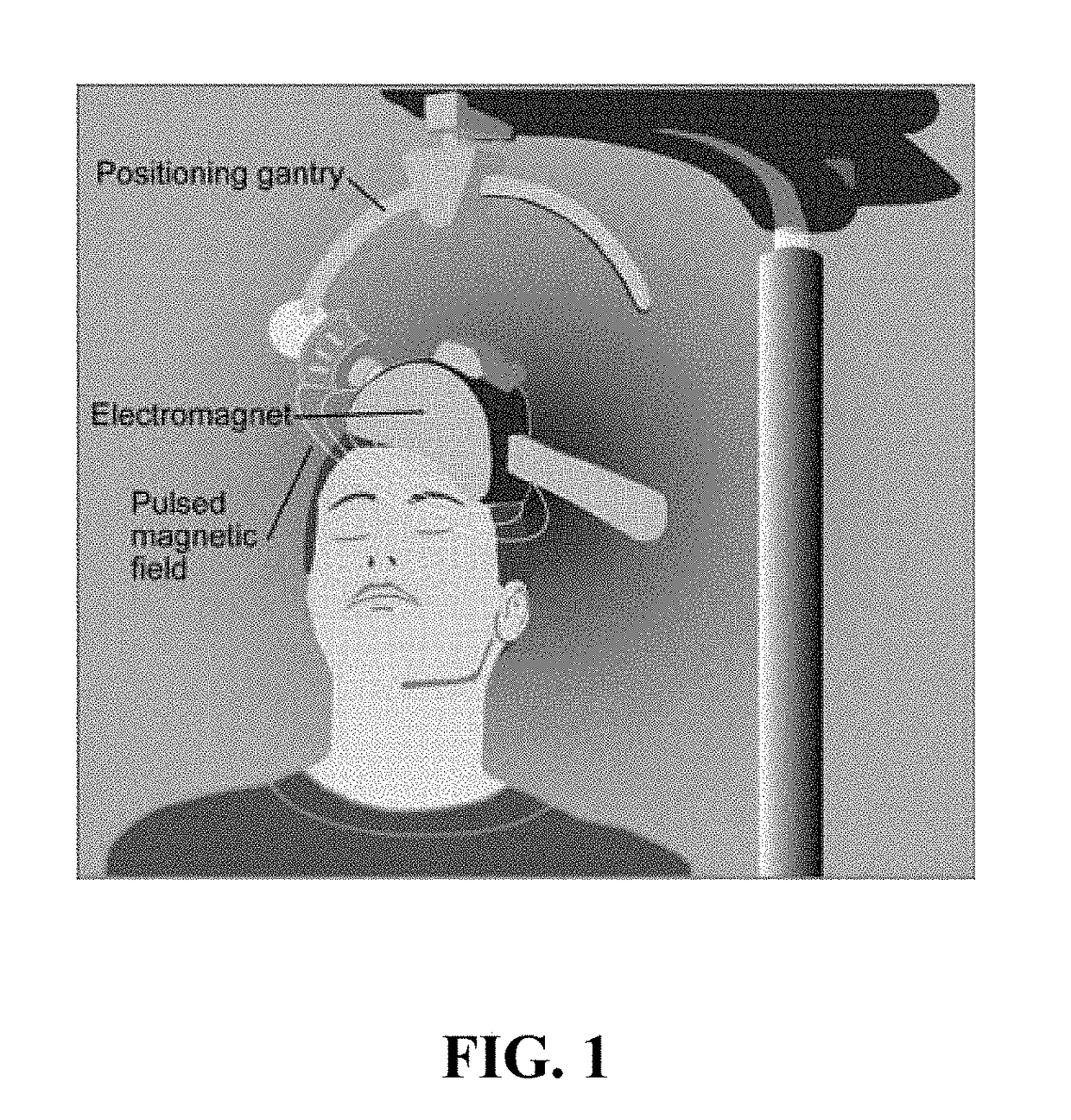 Skull implanted magnet assembly for brain stimulation