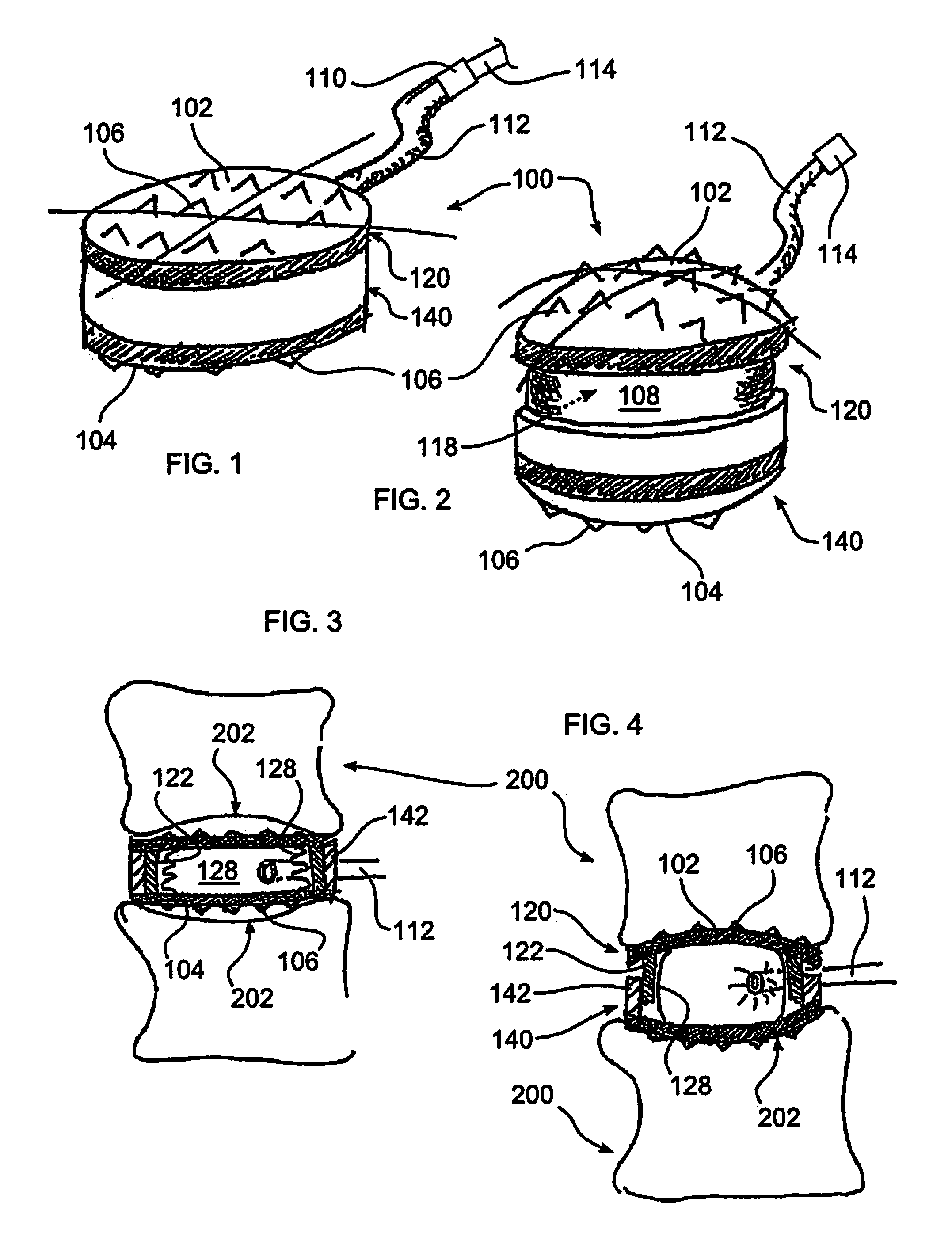 Stabilizing vertebrae with expandable spacers