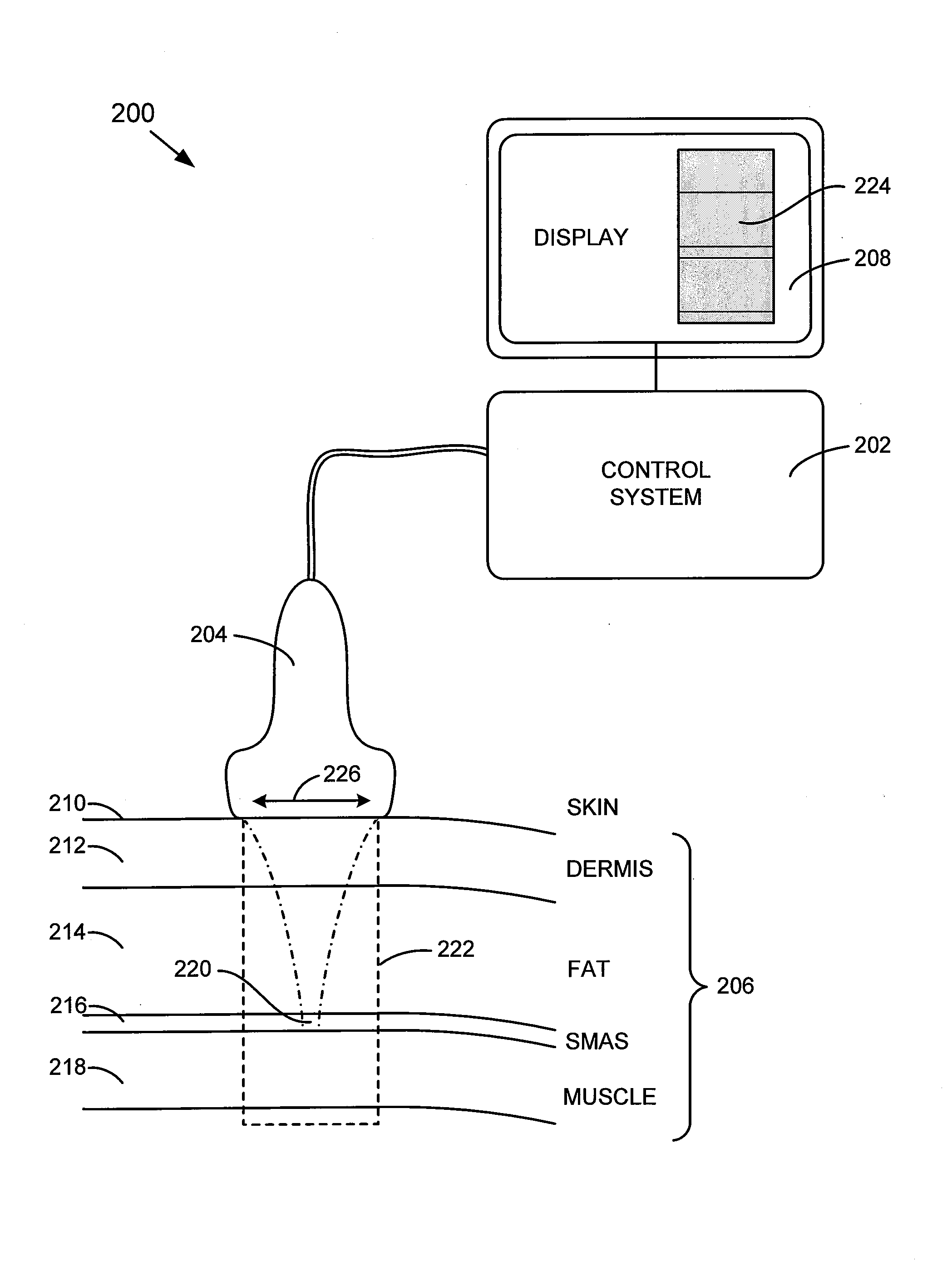 Method and system for noninvasive face lifts and deep tissue tightening