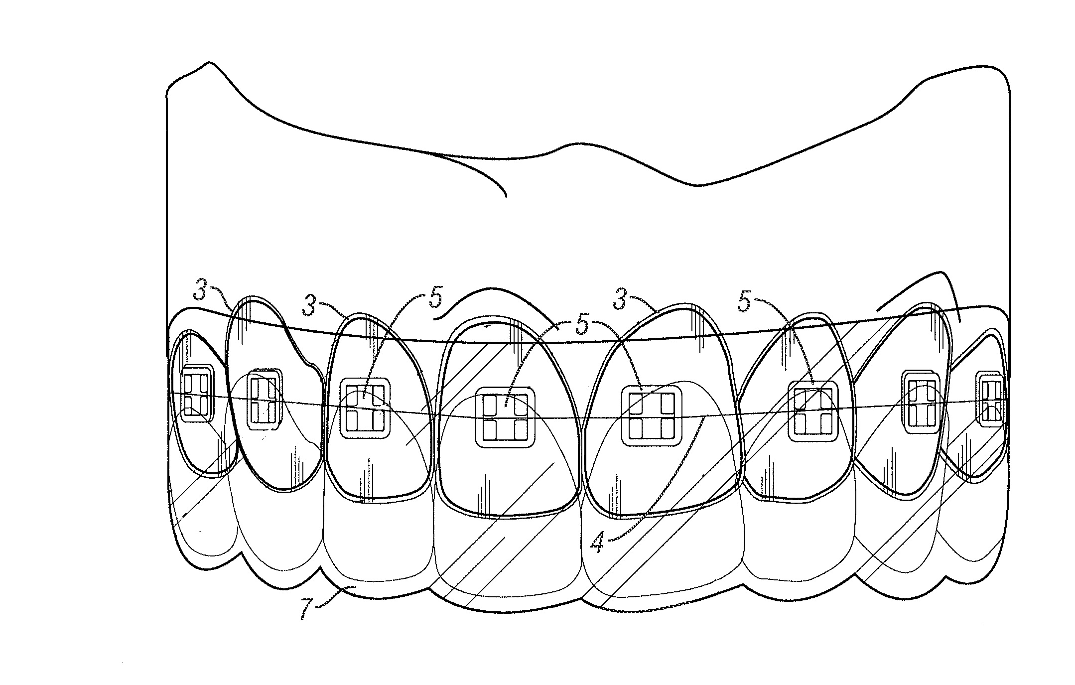 Orthodontic appliance system