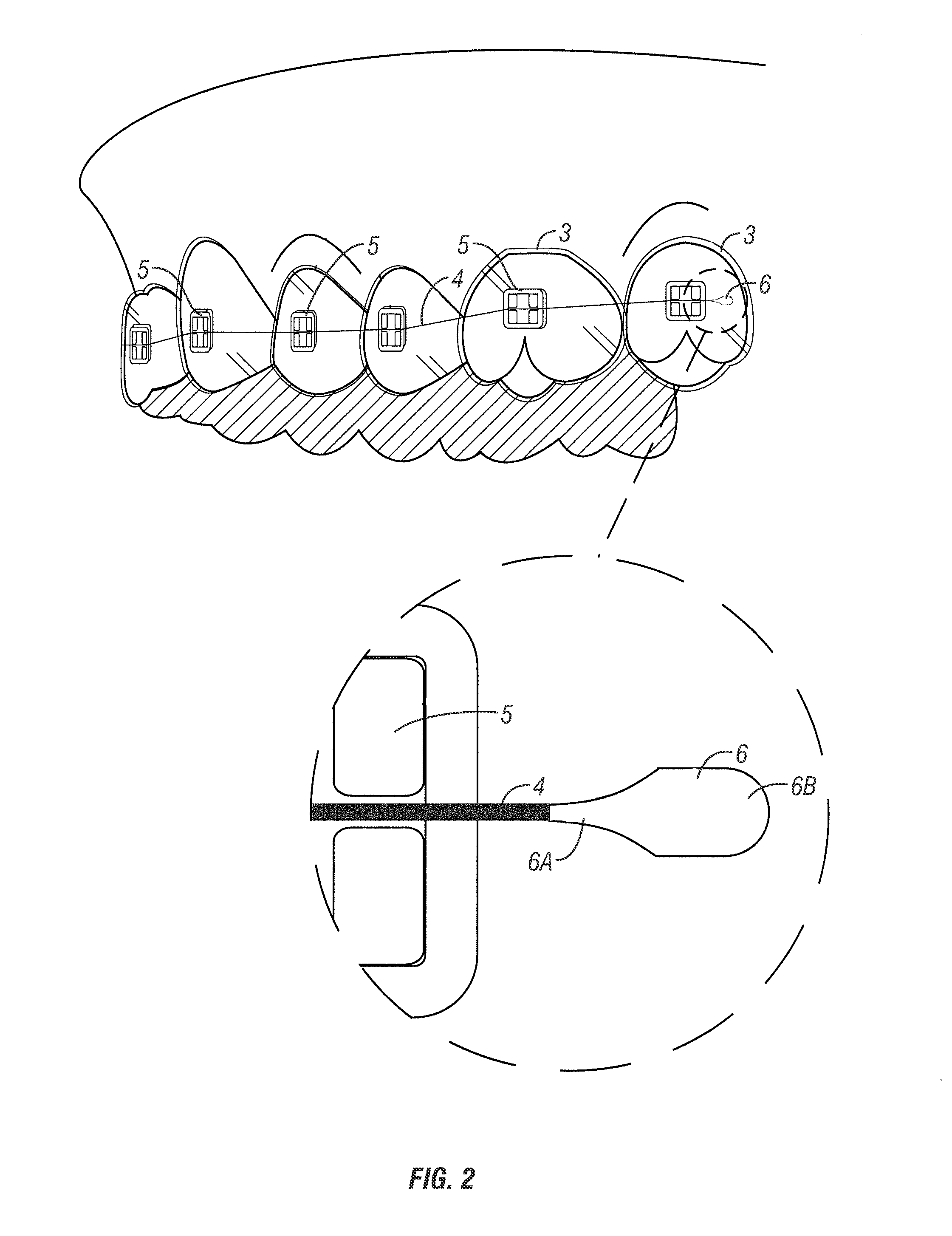 Orthodontic appliance system