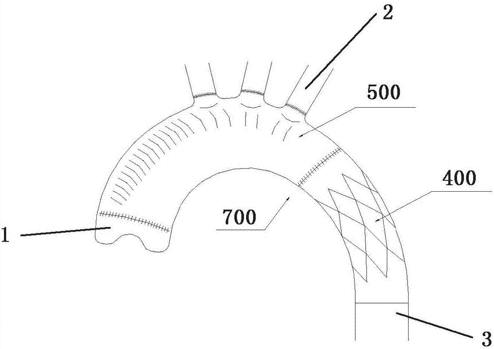 An intraoperative stent system