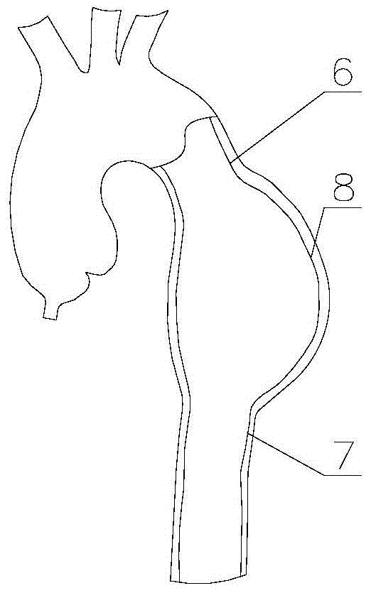 Aortic Dissection Aneurysm Covered Stent Graft