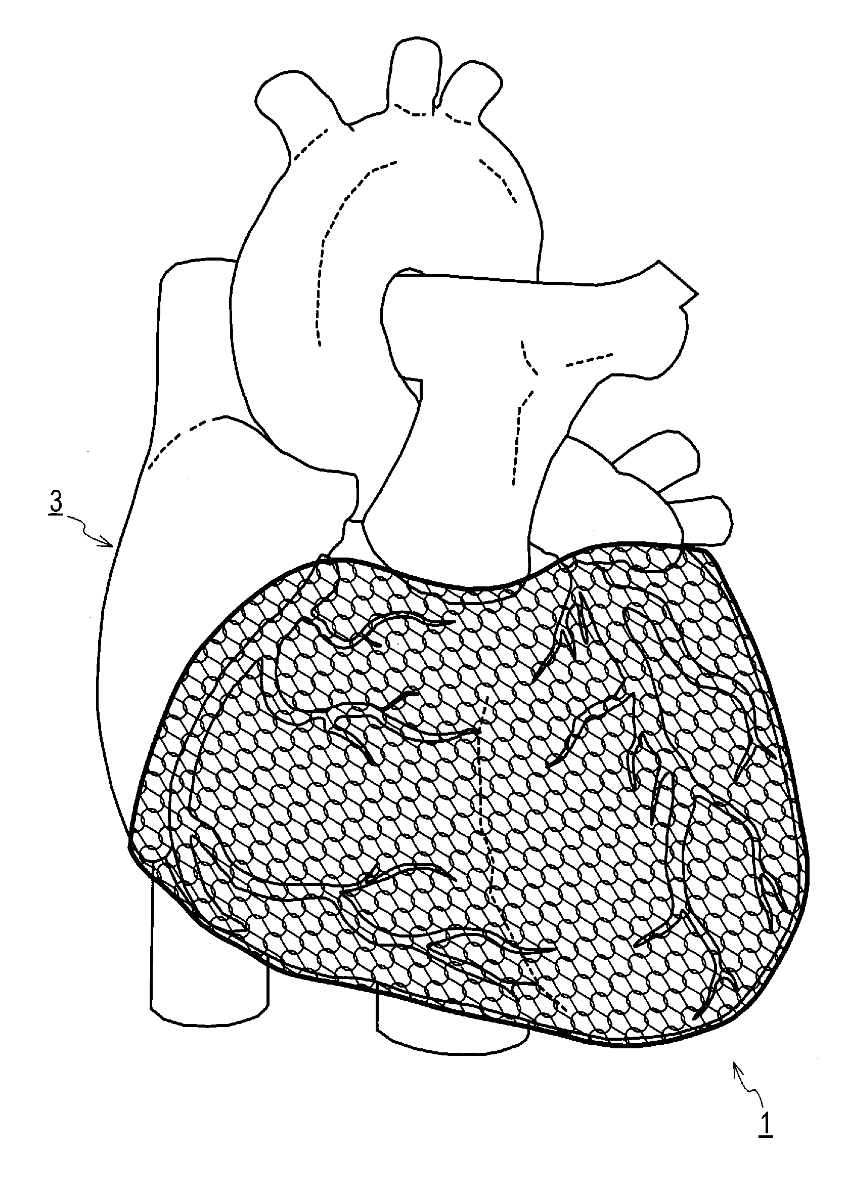 Manufacturing method for heart correction net