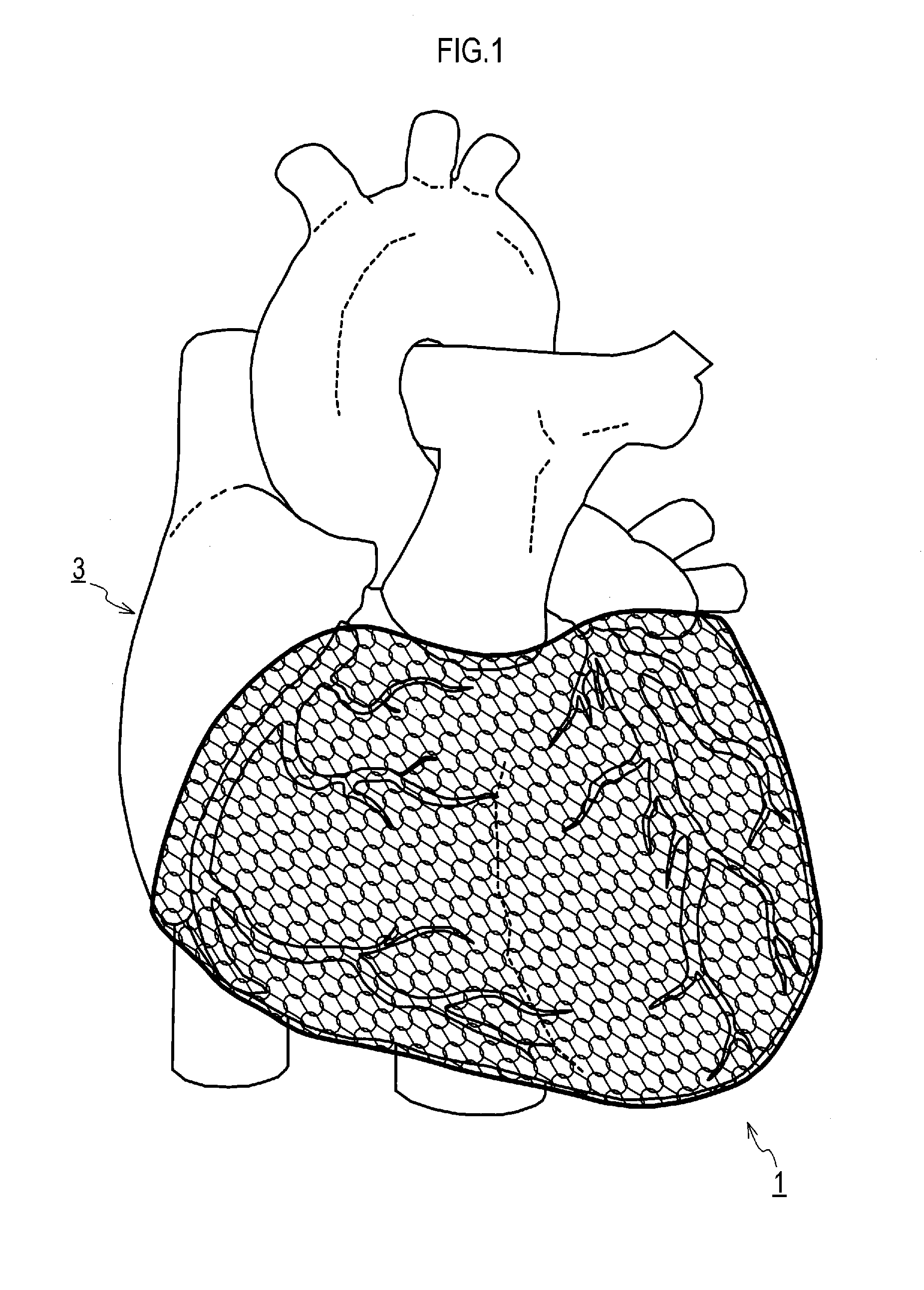 Manufacturing method for heart correction net