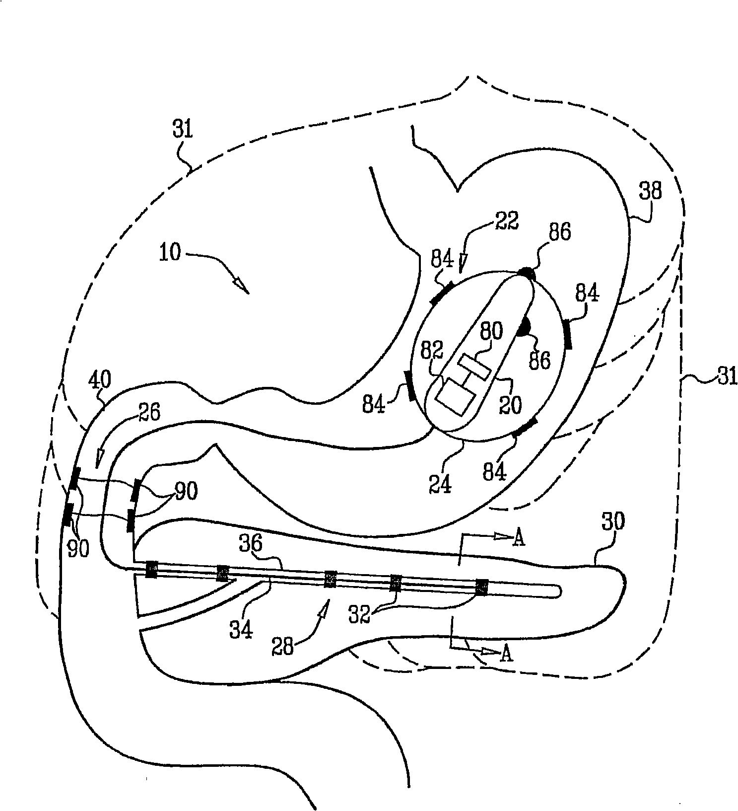 Gi and pancreatic device for treating obesity and diabetes