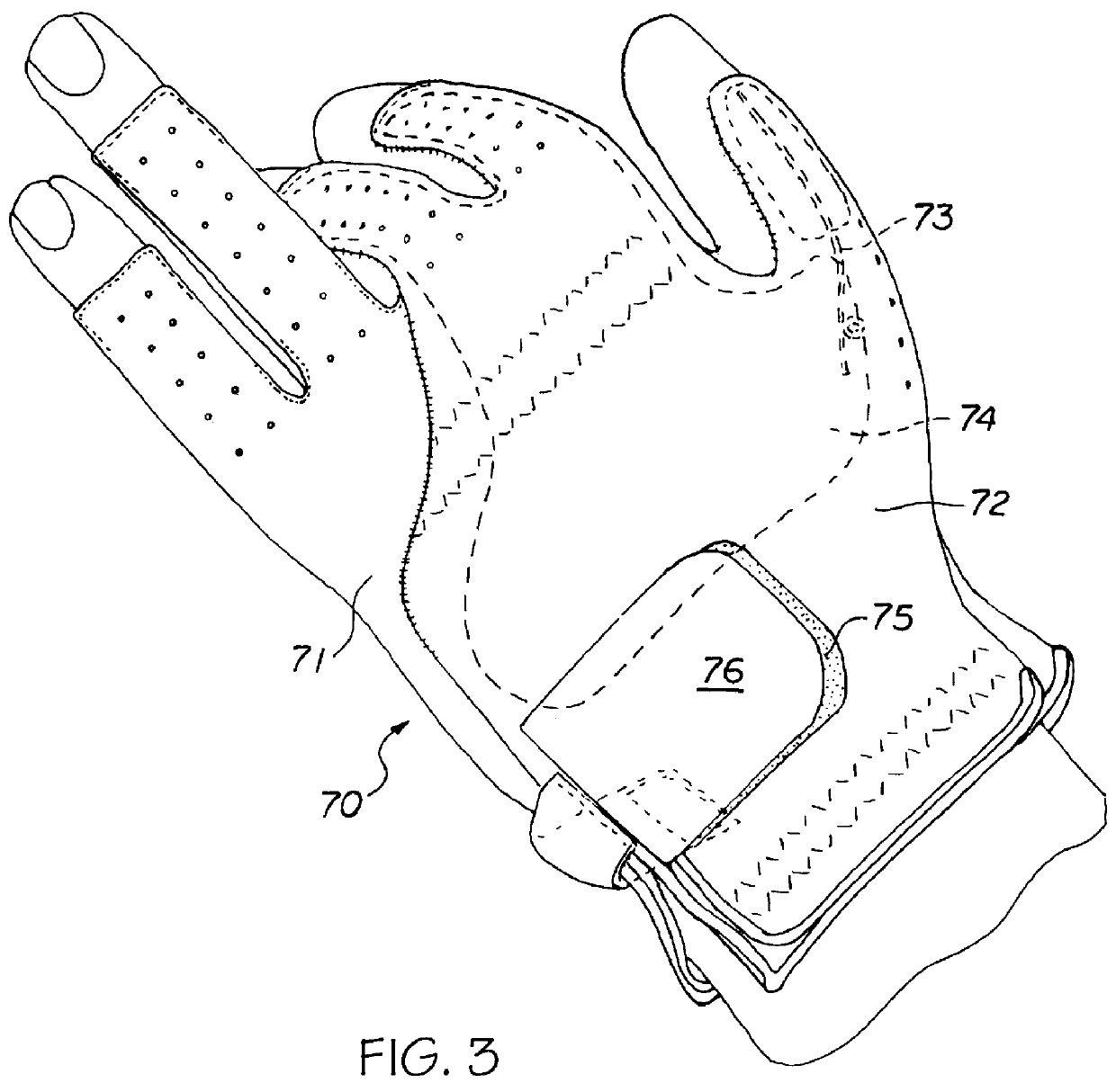 Remedial hand wear article for preventing hyperextension with full distal knuckle flexure