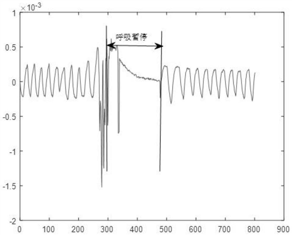 Method for extracting breathing state based on radar signal