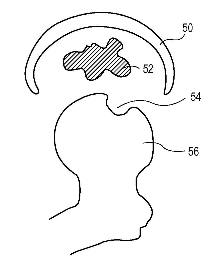 Methods, Devices and Compositions for Adhering Hydrated Polymer Implants to Bone