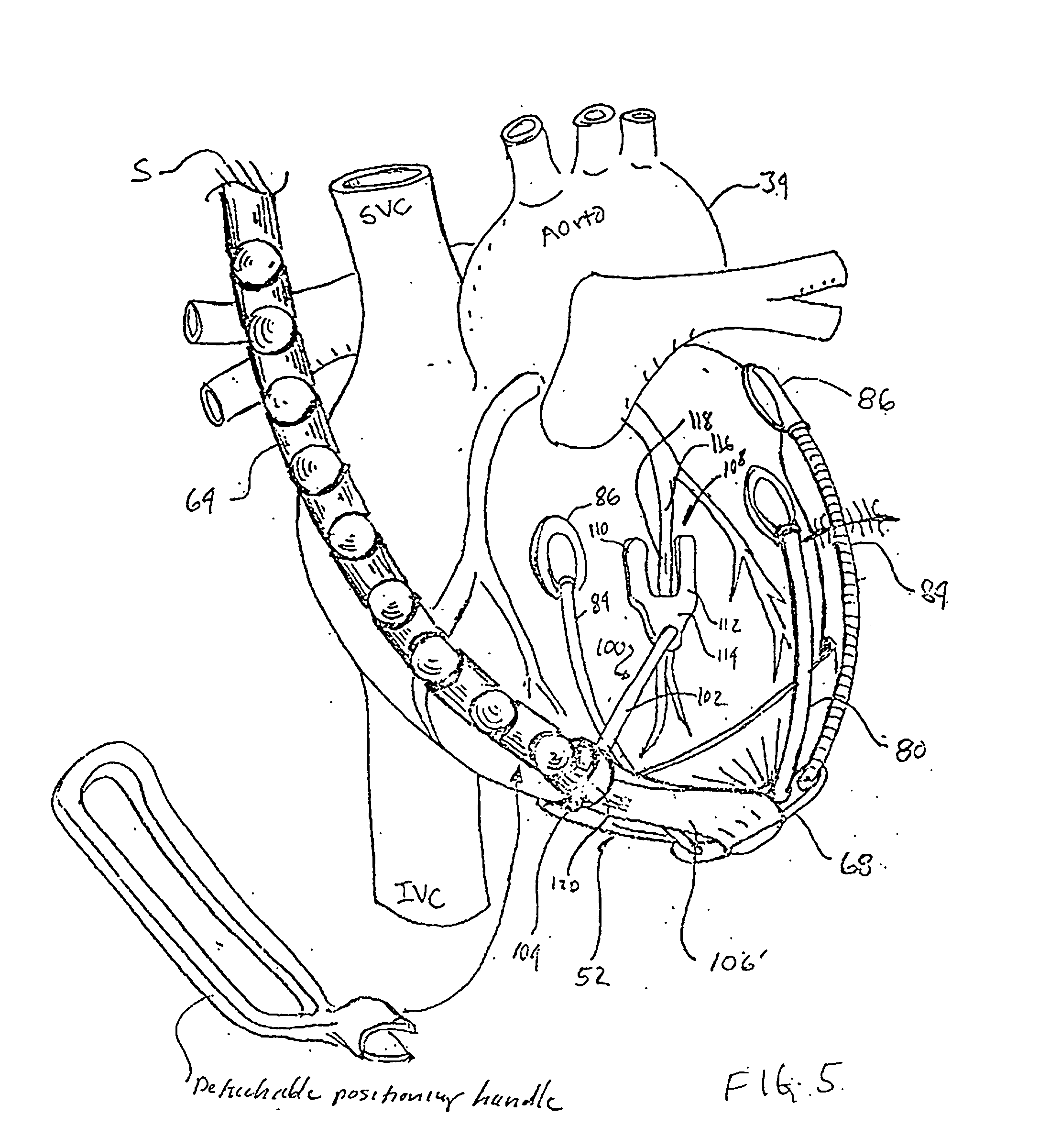 Device to permit offpump beating heart coronary bypass surgery