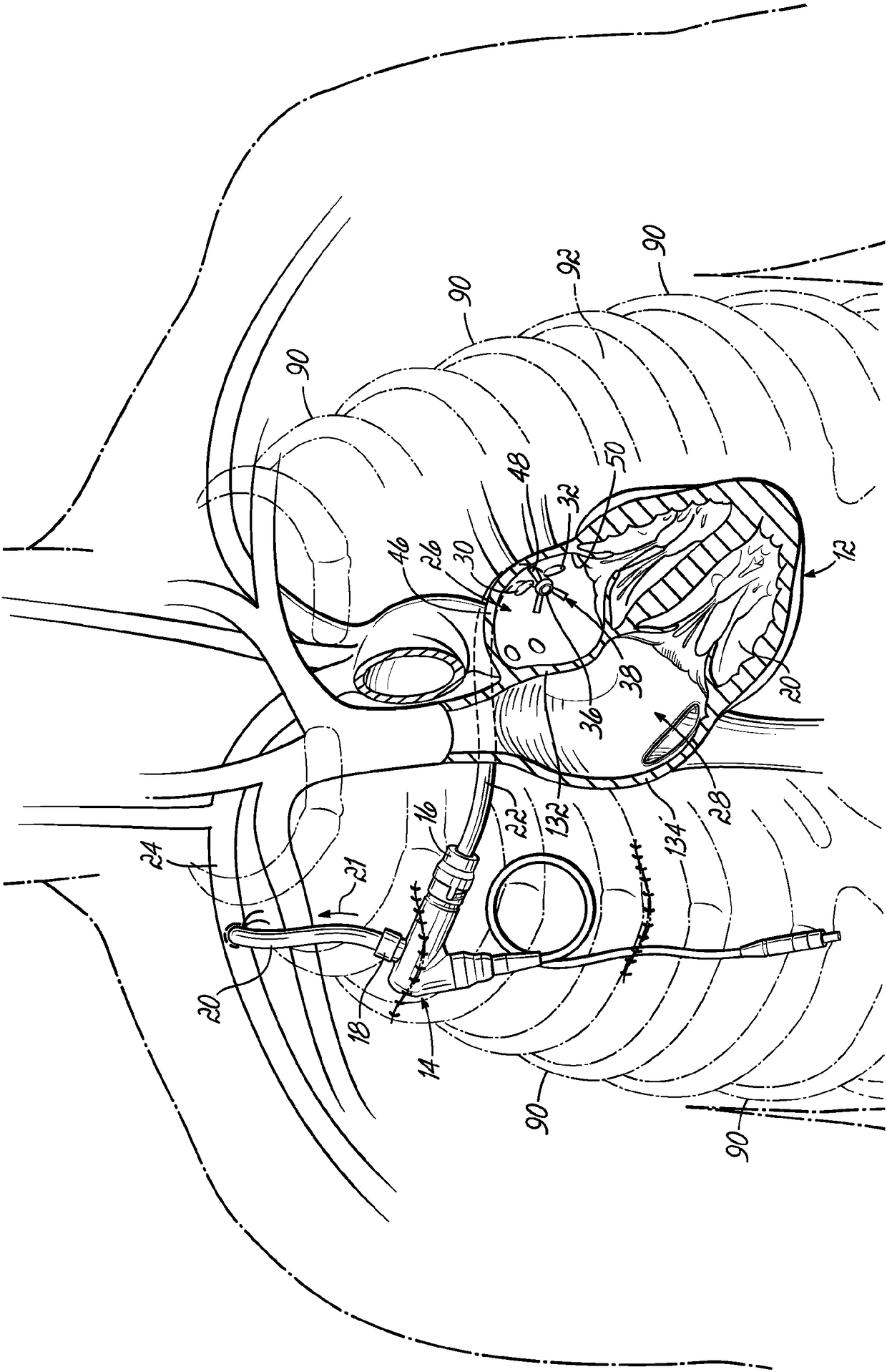 Inflow cannula and blood assist system