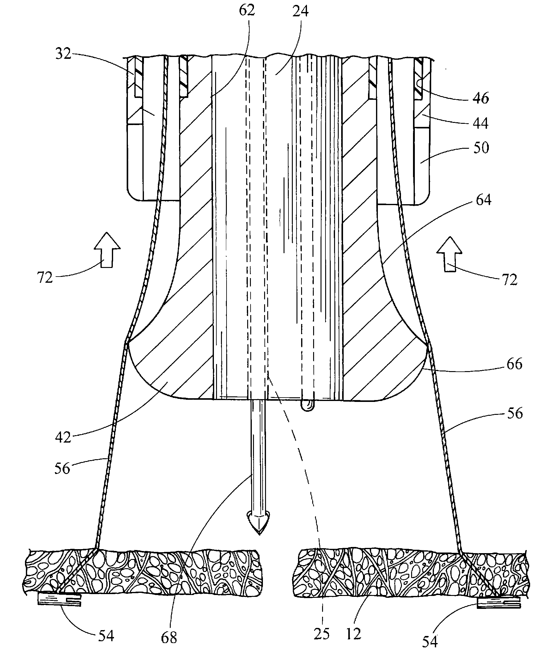 Medical devices, systems and methods for closing perforations