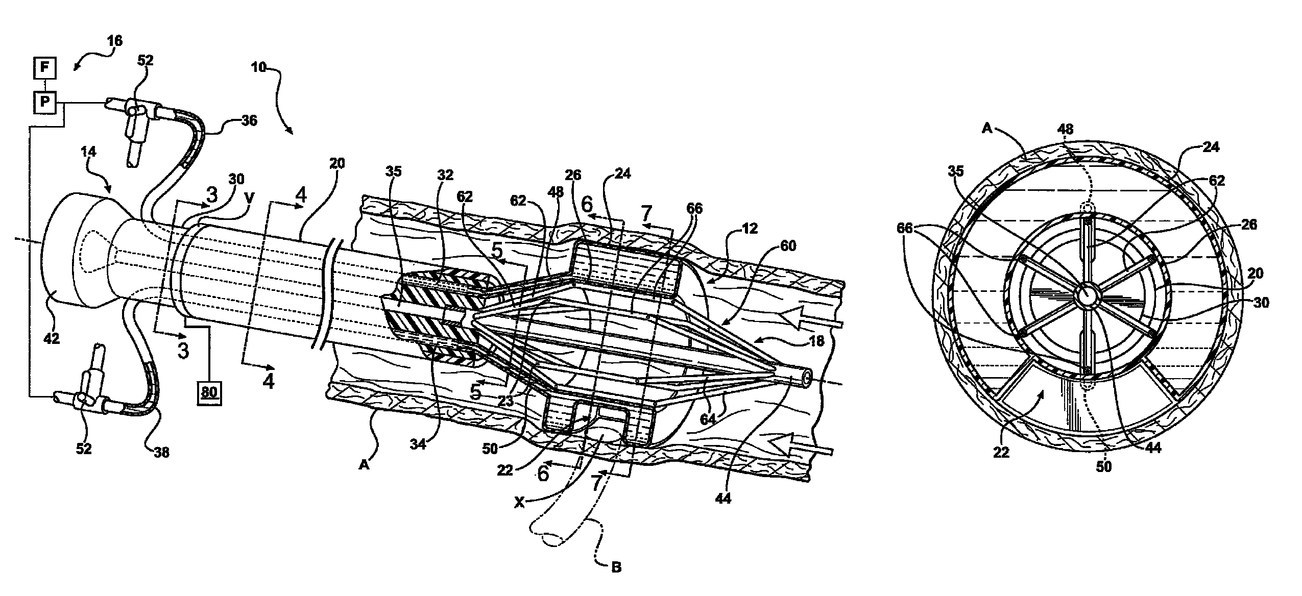 Clampless anastomotic device