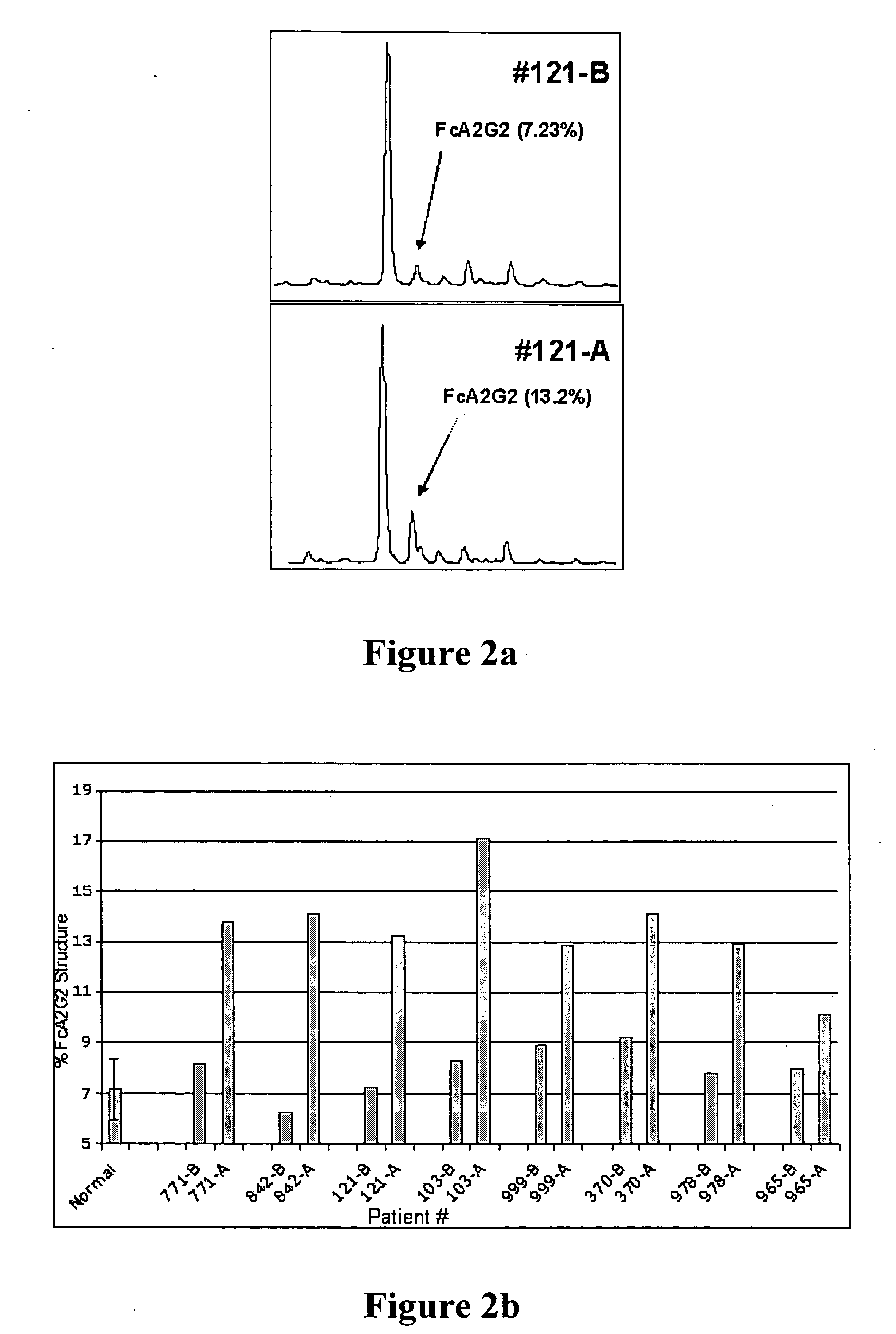 Diagnosis of liver pathology through assessment of protein glycosylation