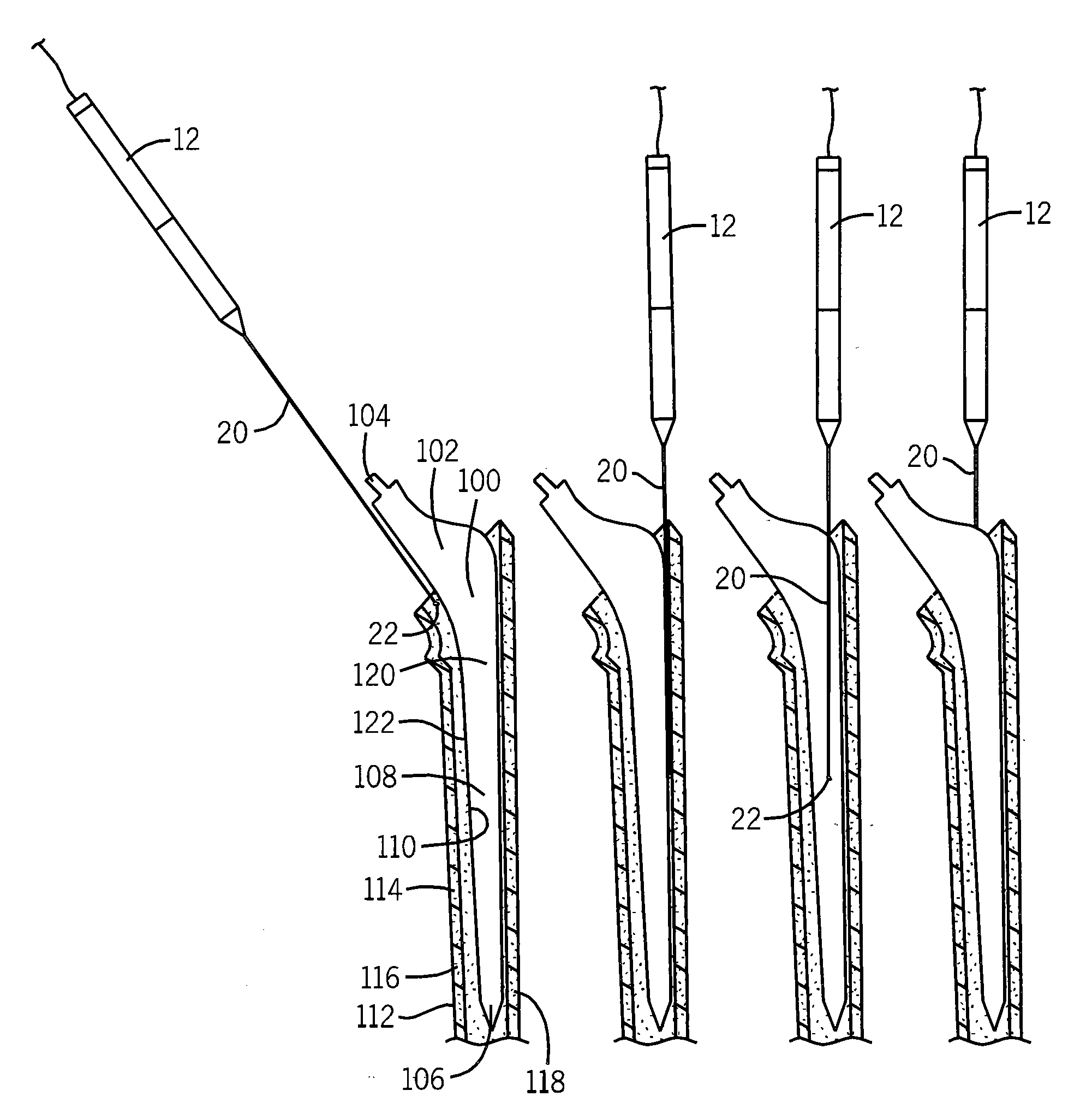 Laser Focused Ablation Apparatus and Method of Use in Revision Arthroplasty