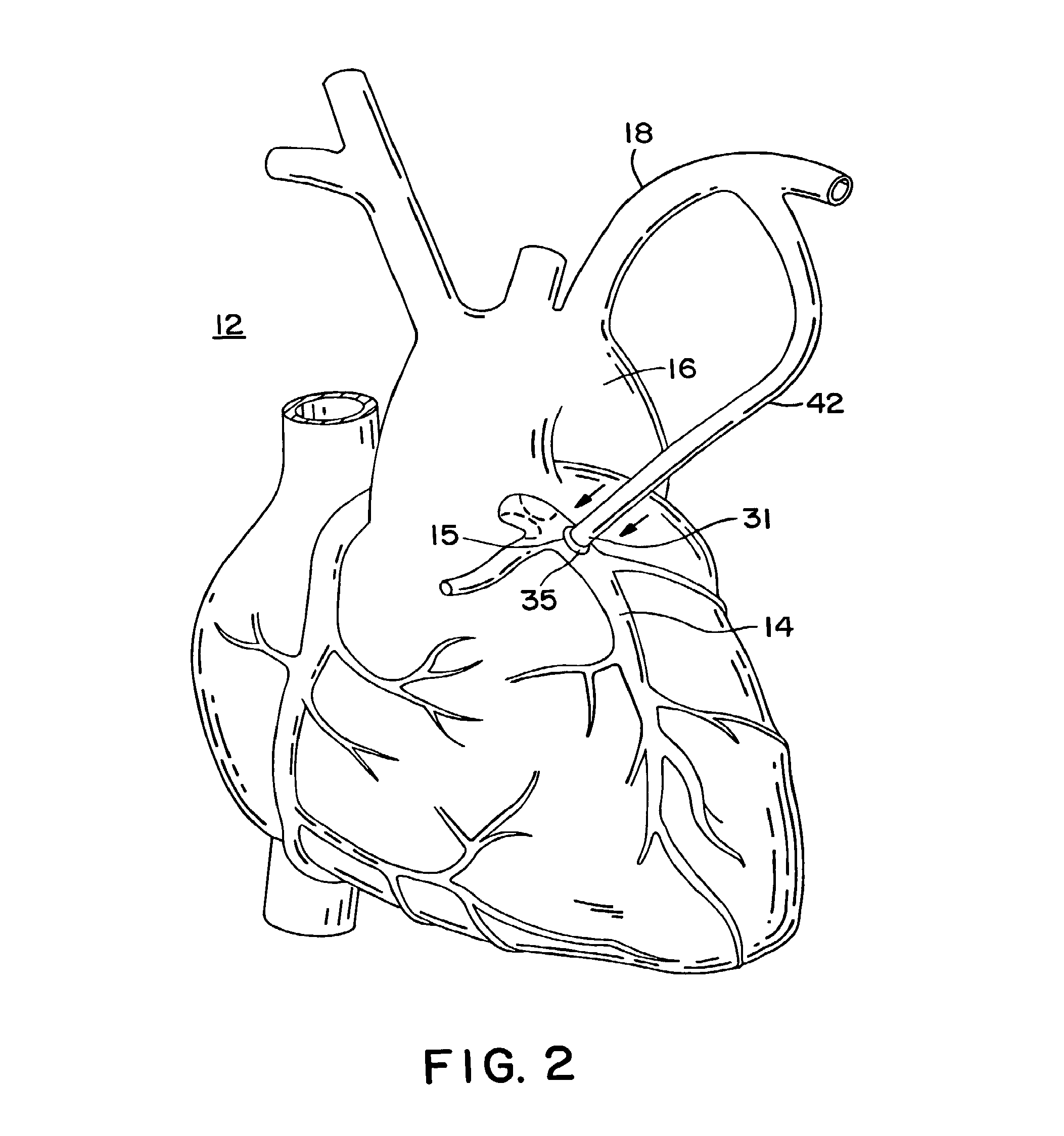 Methods and apparatus for making precise incisions in body vessels