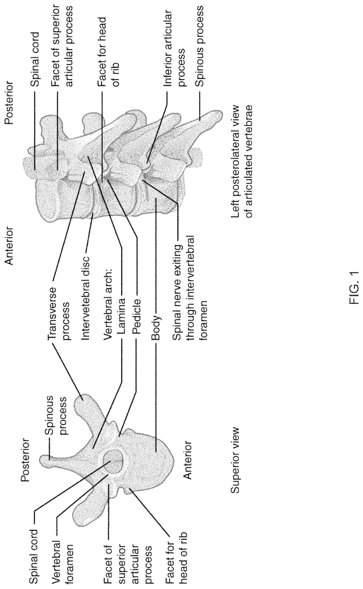 Robot assisted volume removal during surgery