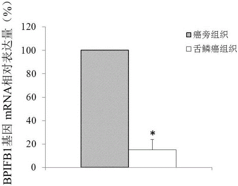 Novel application of BPIFB1 to preparing tongue squamous cell carcinoma diagnosis and treatment preparations