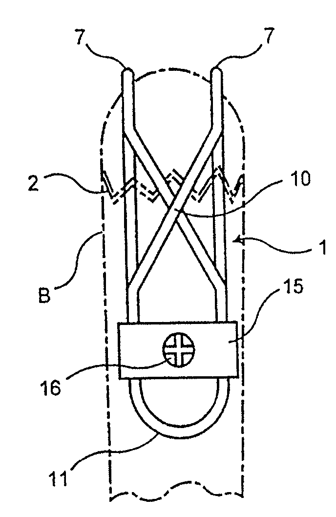 Guide system and associated method for installing an implant device adapted to apply compression across a fracture site