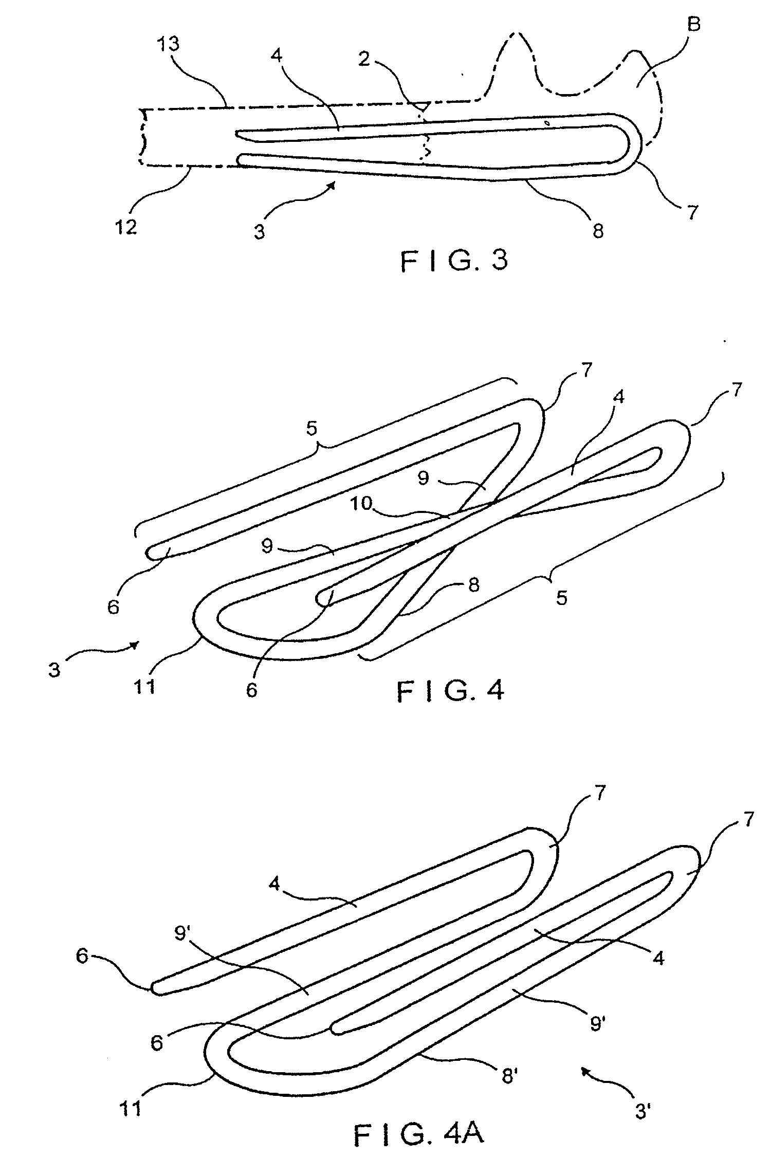 Guide system and associated method for installing an implant device adapted to apply compression across a fracture site