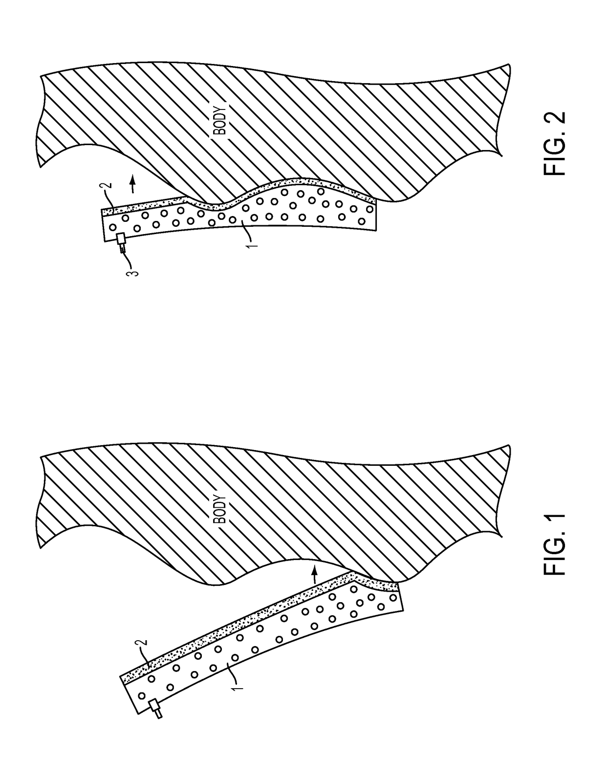 Immobilization device