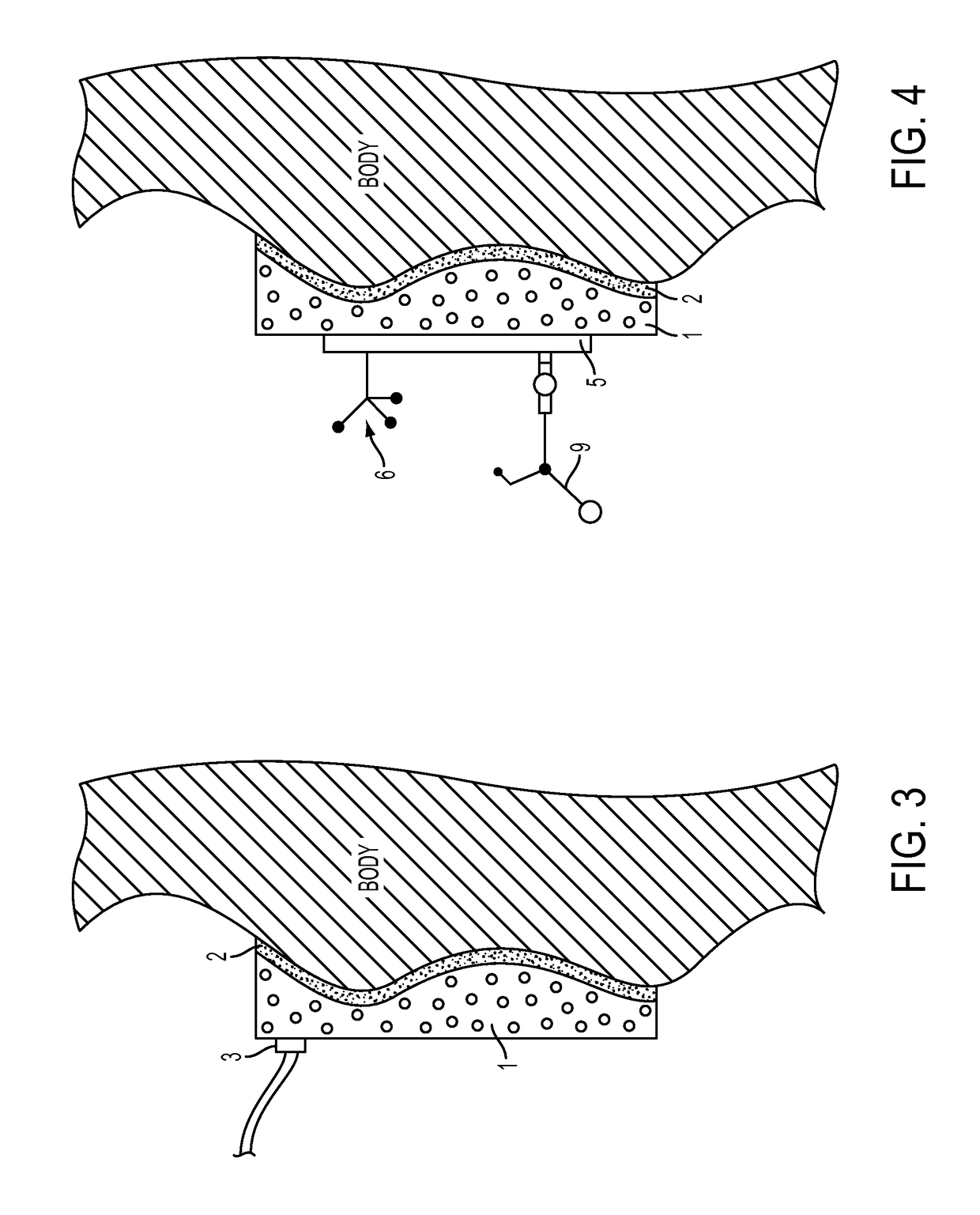 Immobilization device