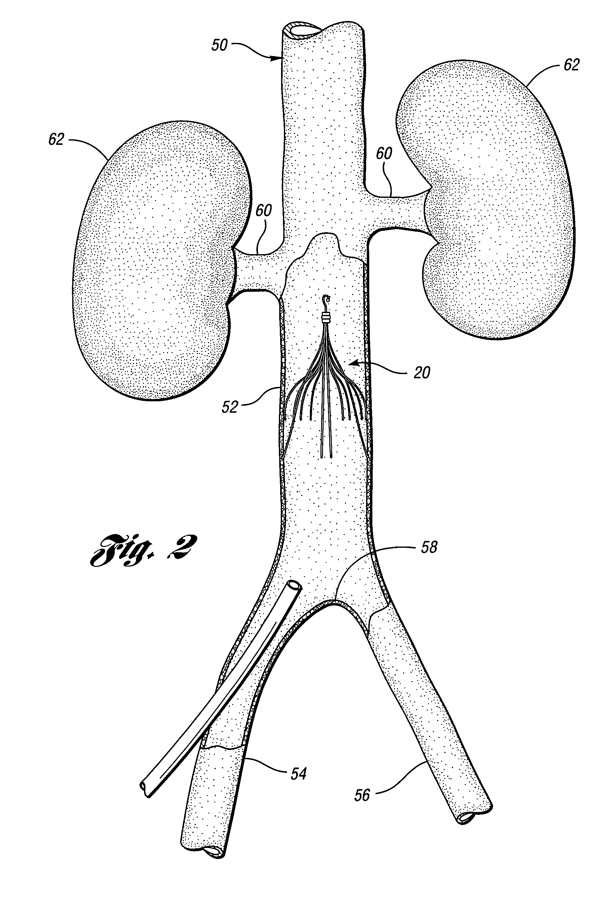 Removable vena cava filter having primary struts for enhanced retrieval and delivery