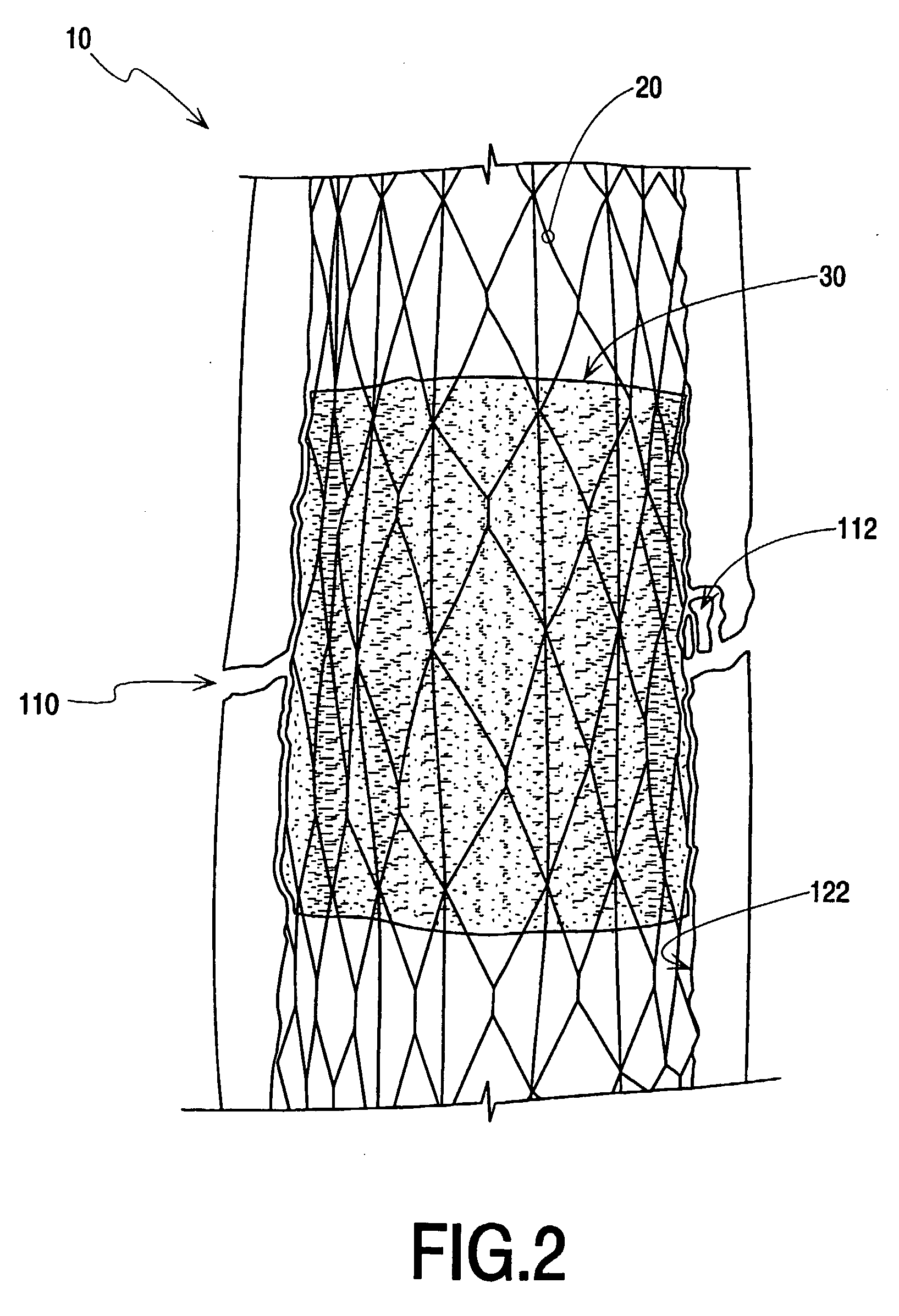 Fracture Fixation and Site Stabilization System