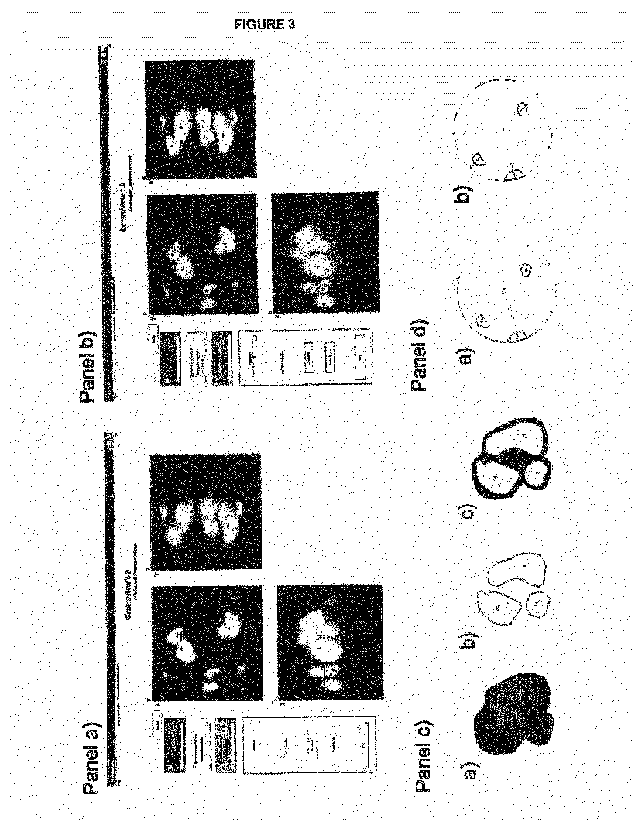 Methods of Detecting and Monitoring Cancer Using 3D Analysis of Centromeres