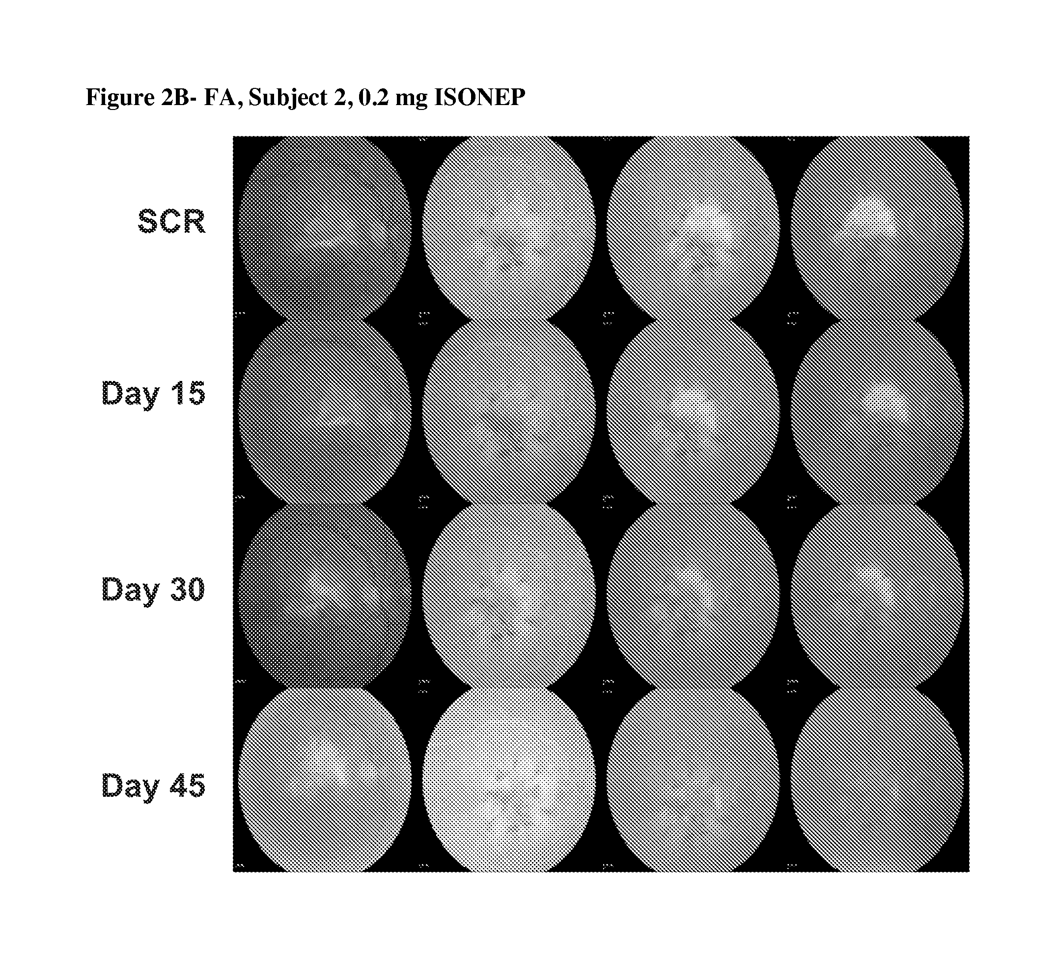 Anti-s1p antibody treatment of patients with ocular disease