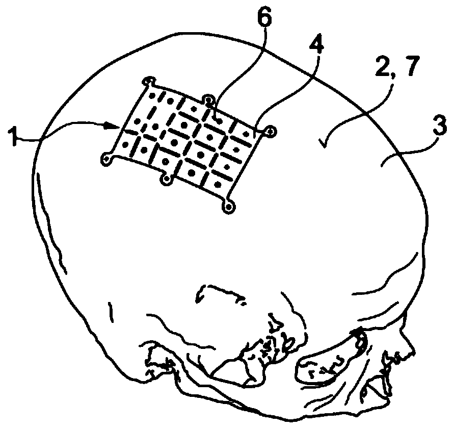 Bone implant for attaching to surface of bone