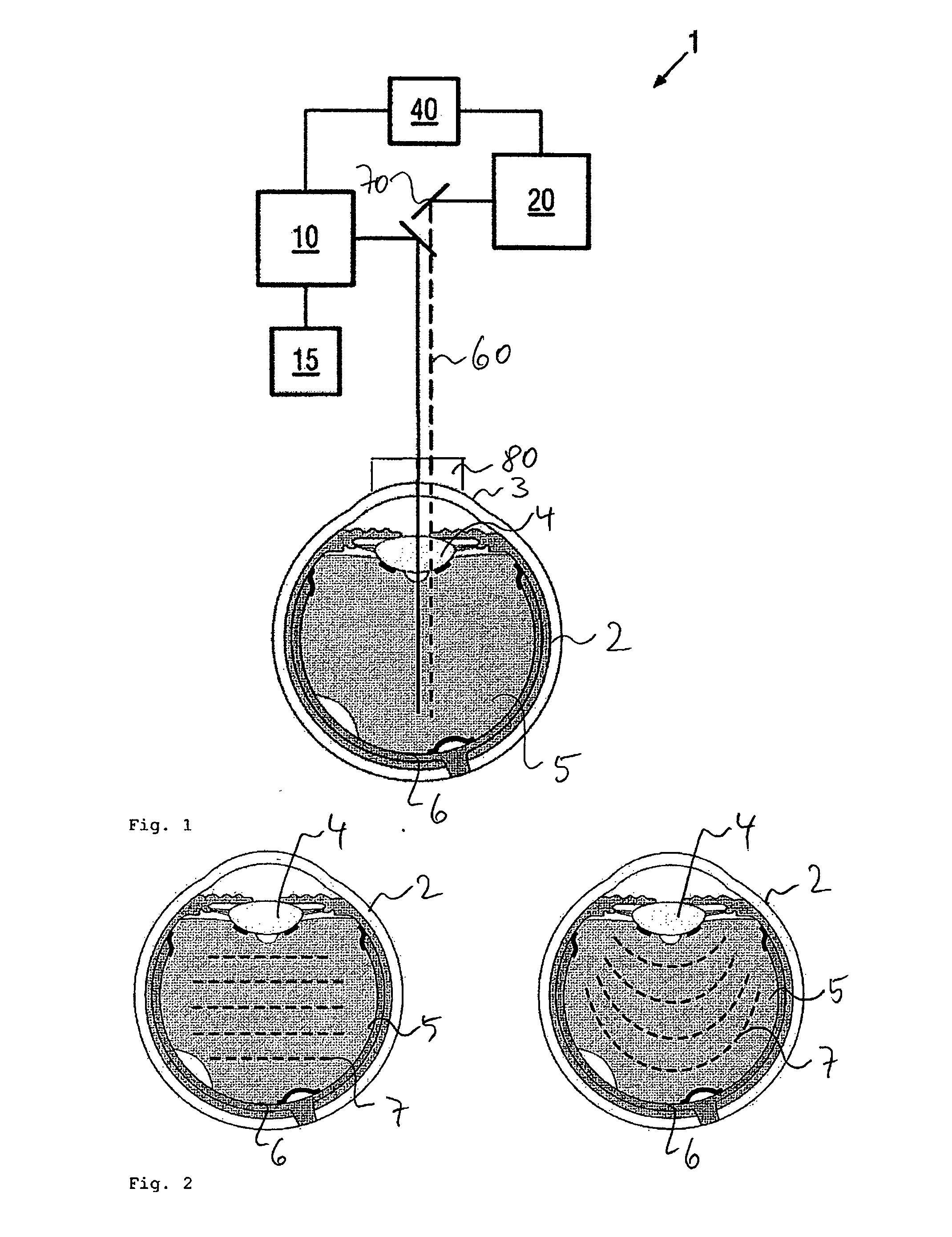 Device and method for vitreous humor surgery