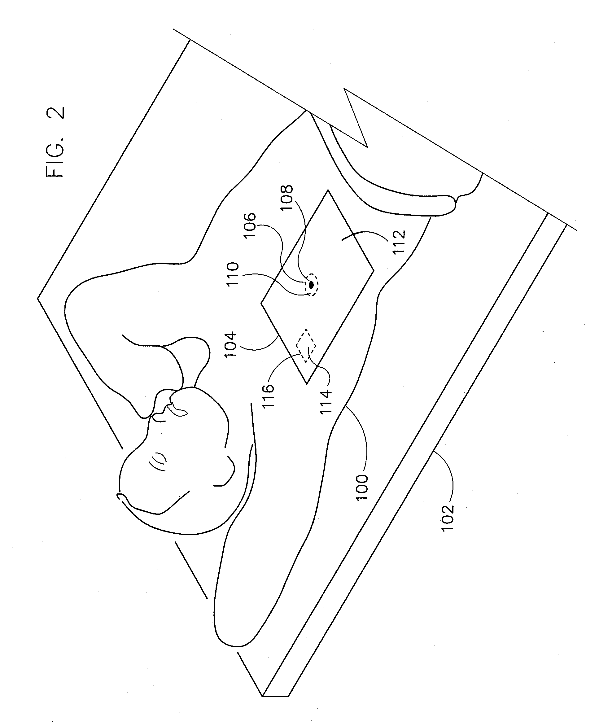 Method and apparatus for correcting distortion in mr images caused by metallic implants