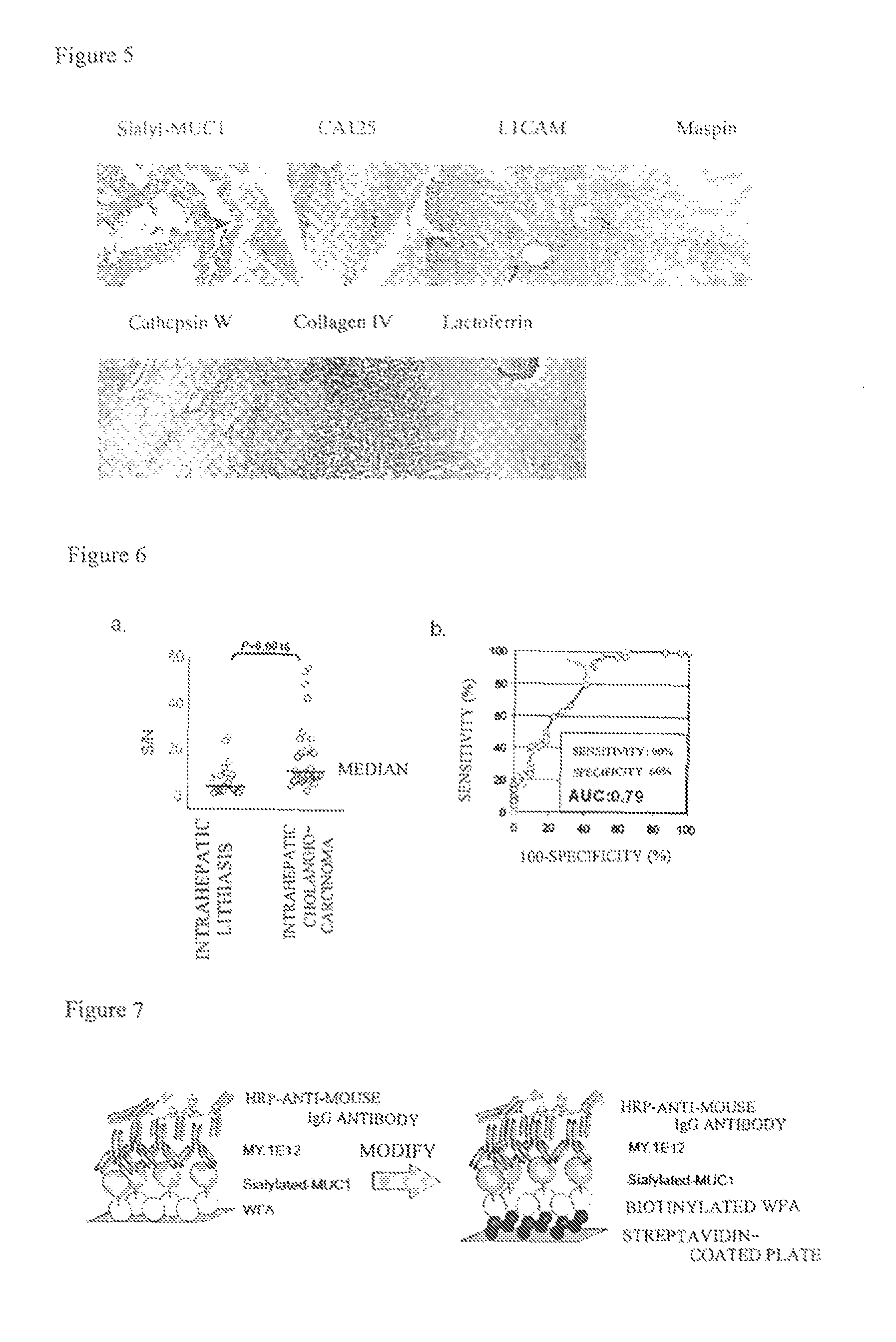 Method for detecting and distinguishing intrahepatic cholangiocarcinoma