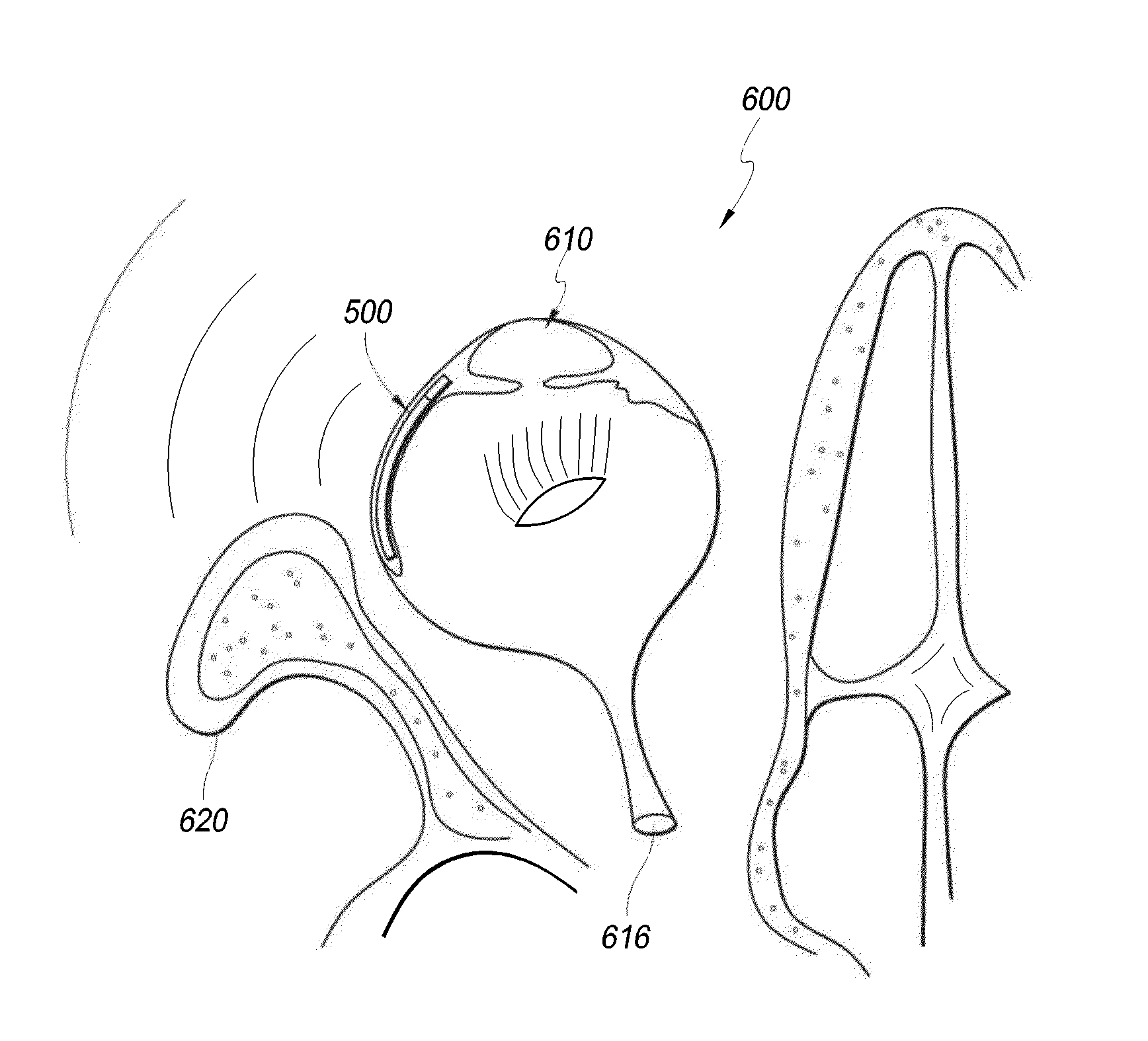 Intraocular physiological sensor