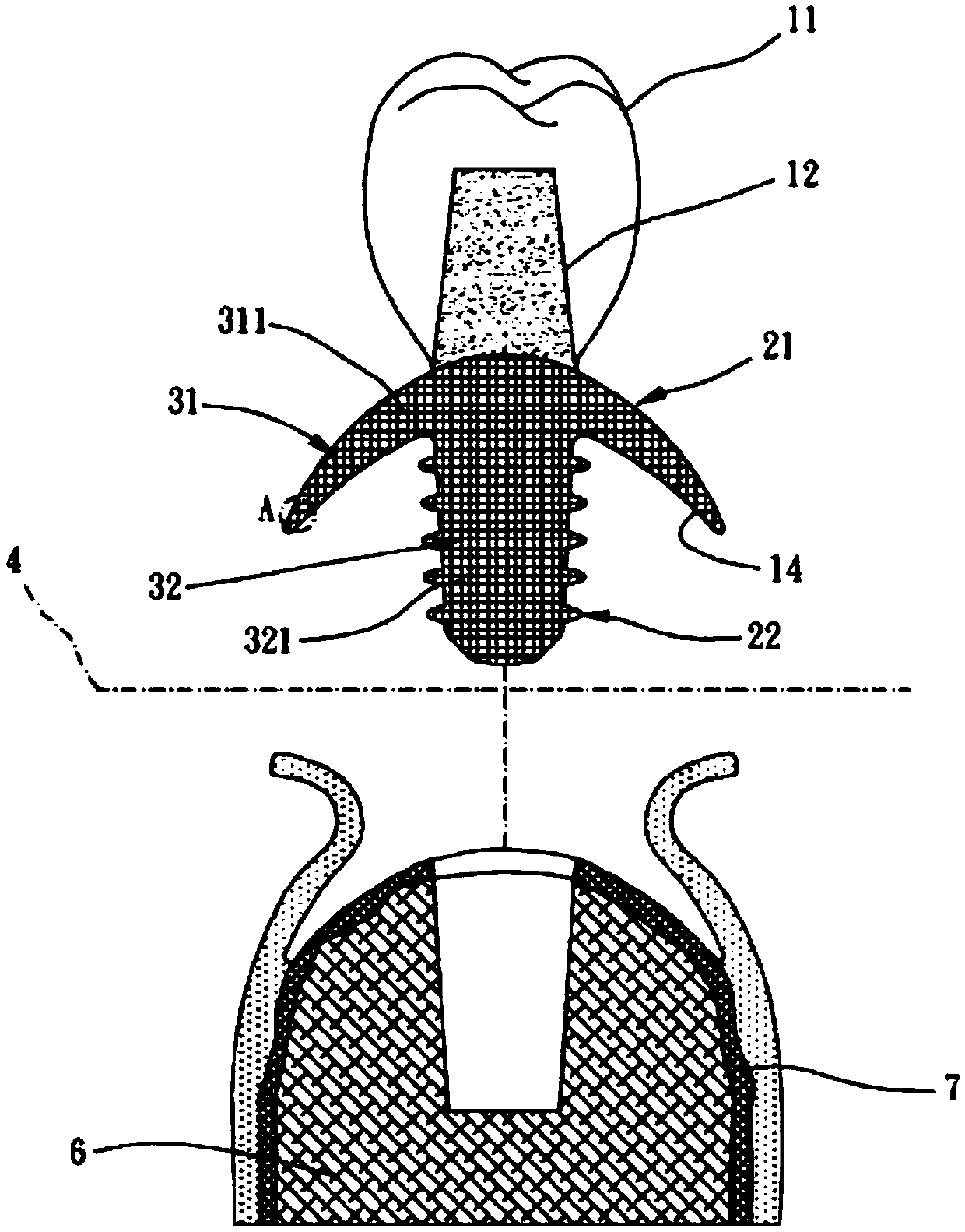 Artificial tooth body having vertical type bone beam structure