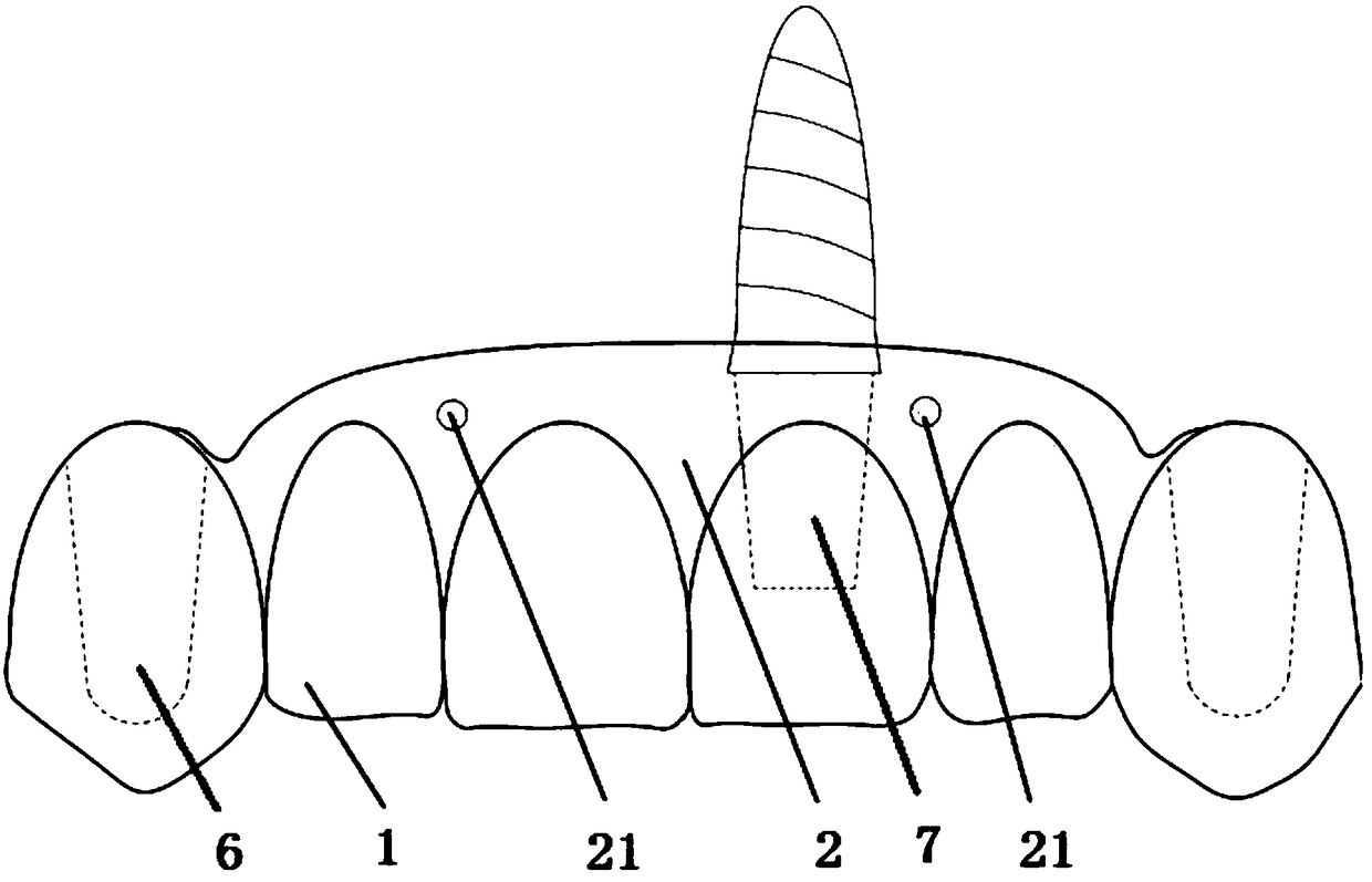 Fixing false tooth false gingiva attachment body and manufacturing method thereof