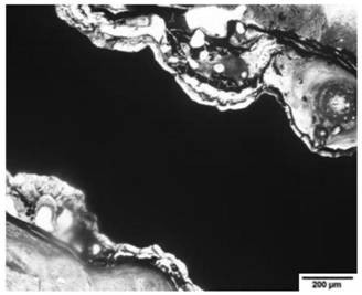 A degradable bone rod implantation device and its preparation method