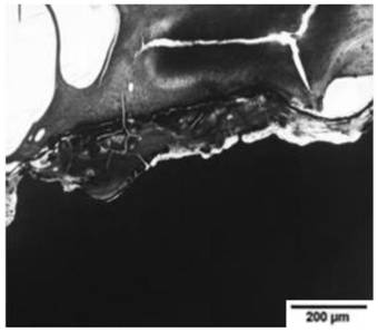 A degradable bone rod implantation device and its preparation method