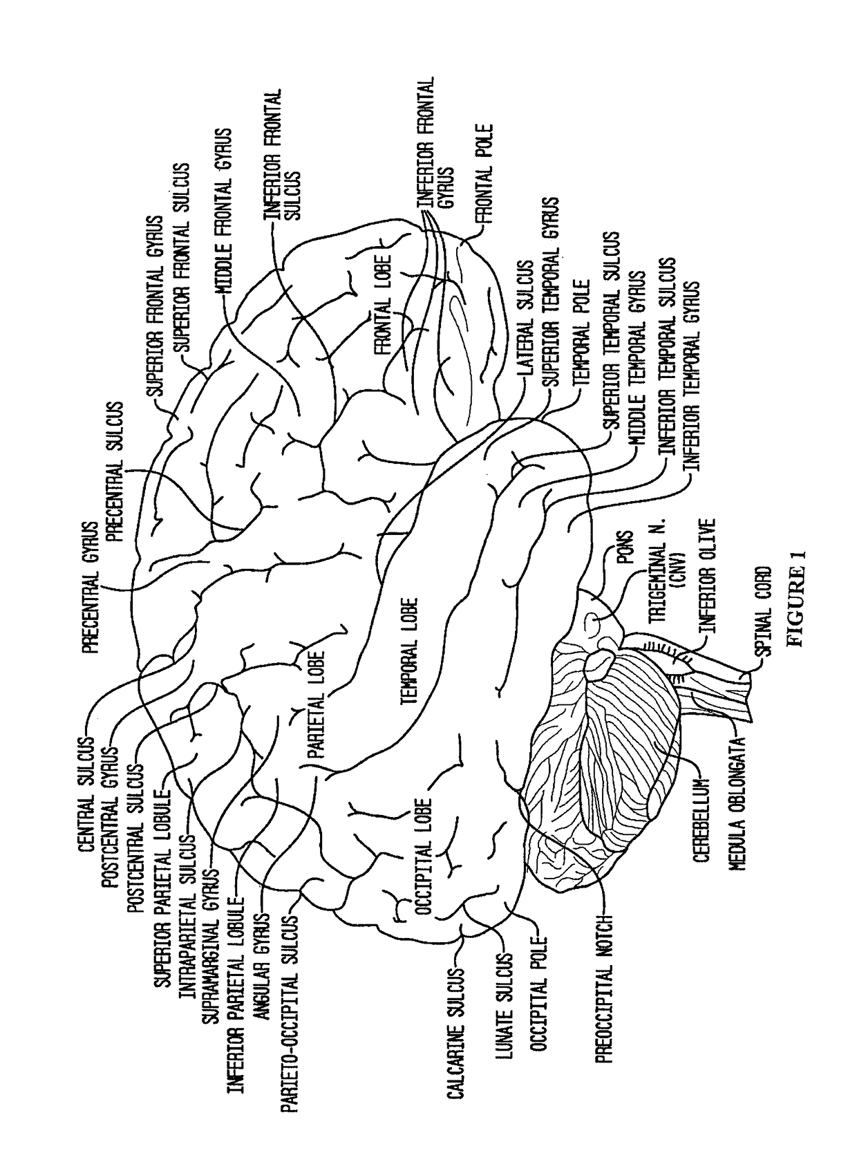 Compositions and their use to treat complications of aneurysmal subarachnoid hemorrhage