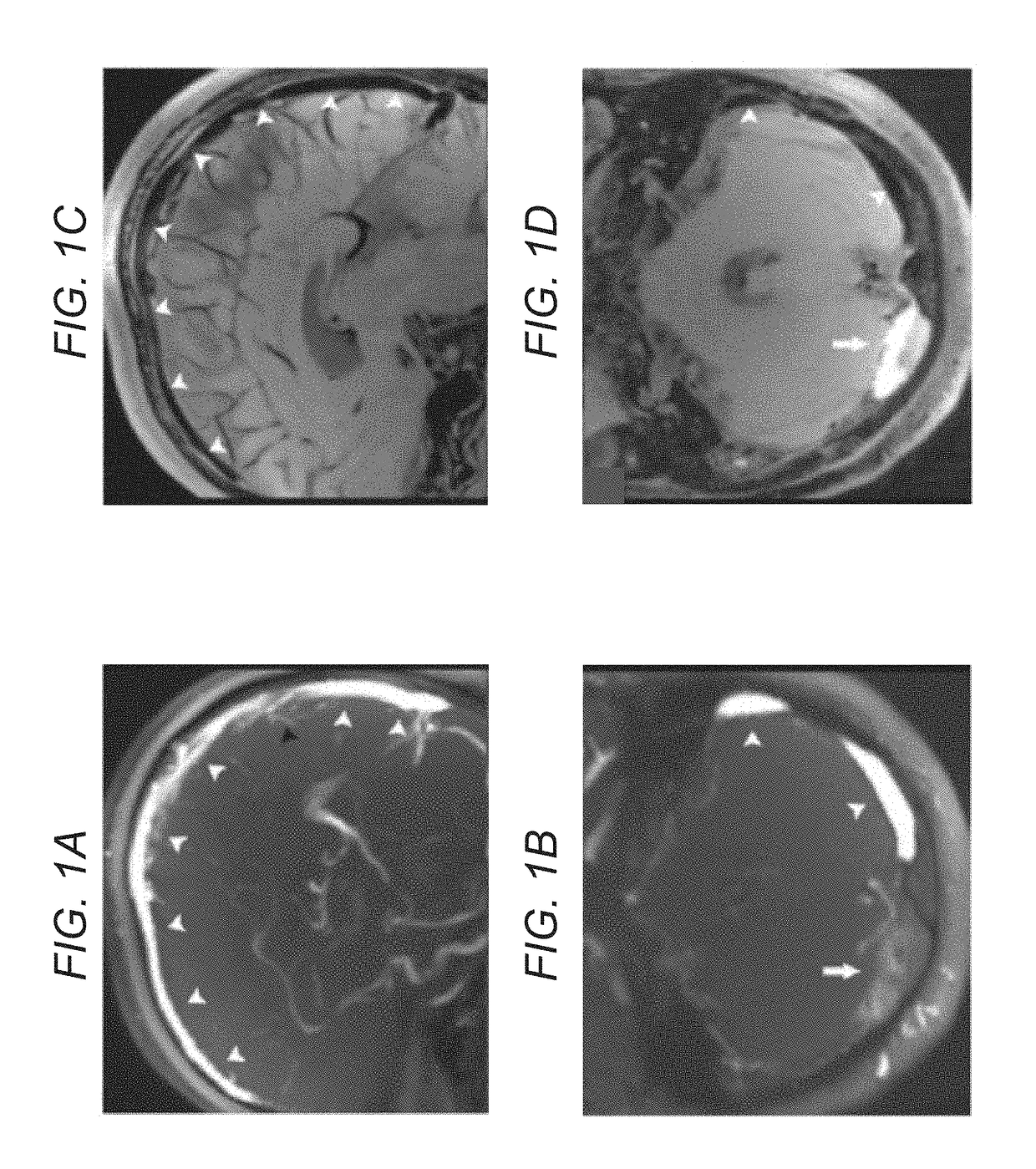 Systems and methods for magnetic resonance black-blood thrombus imaging in detection of cerebral venous thrombosis