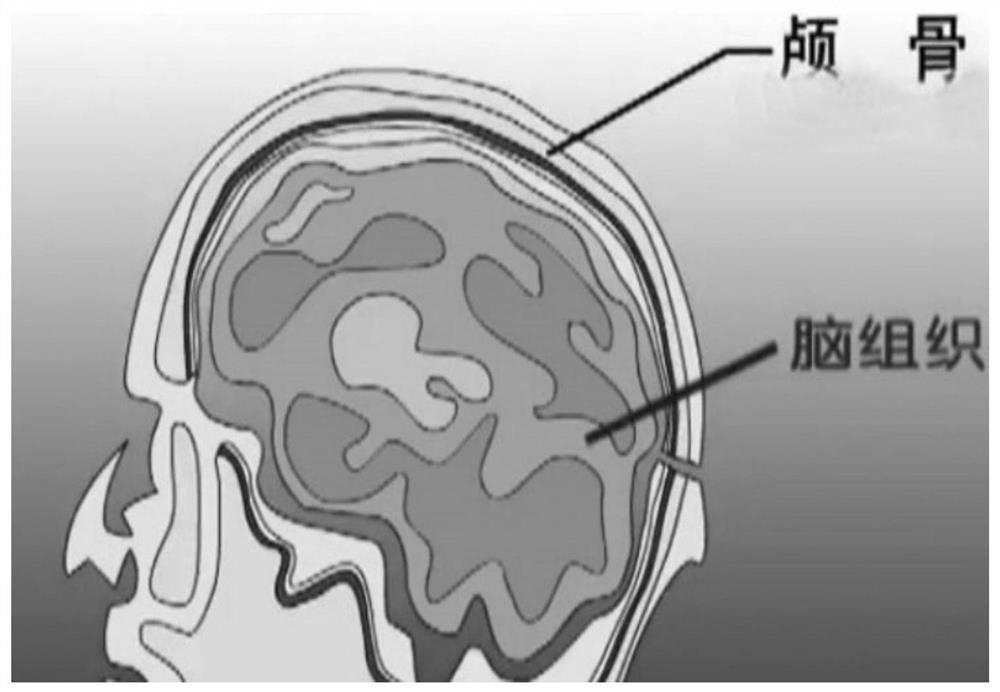 Craniotomy incision shape detection system and corresponding terminal