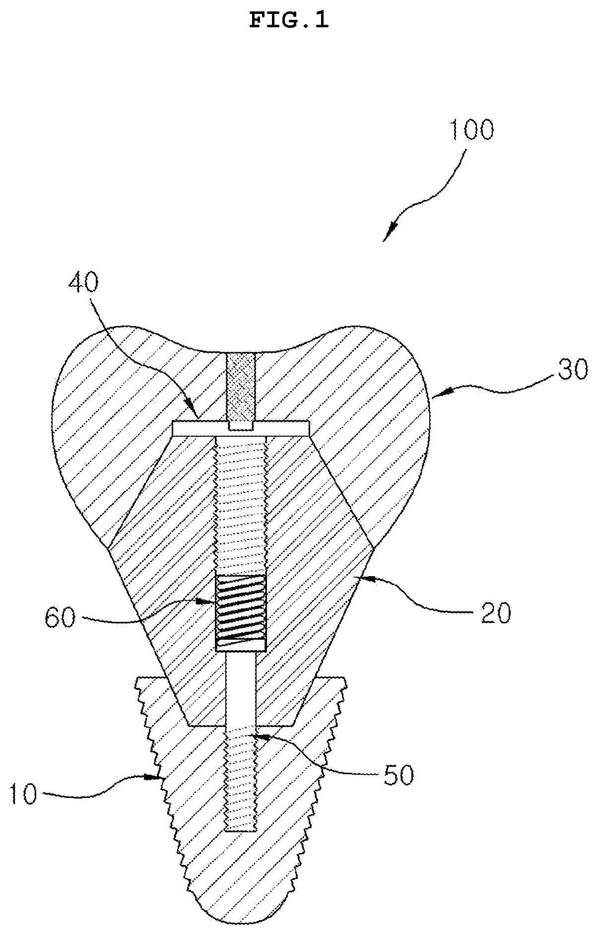 Dental implant