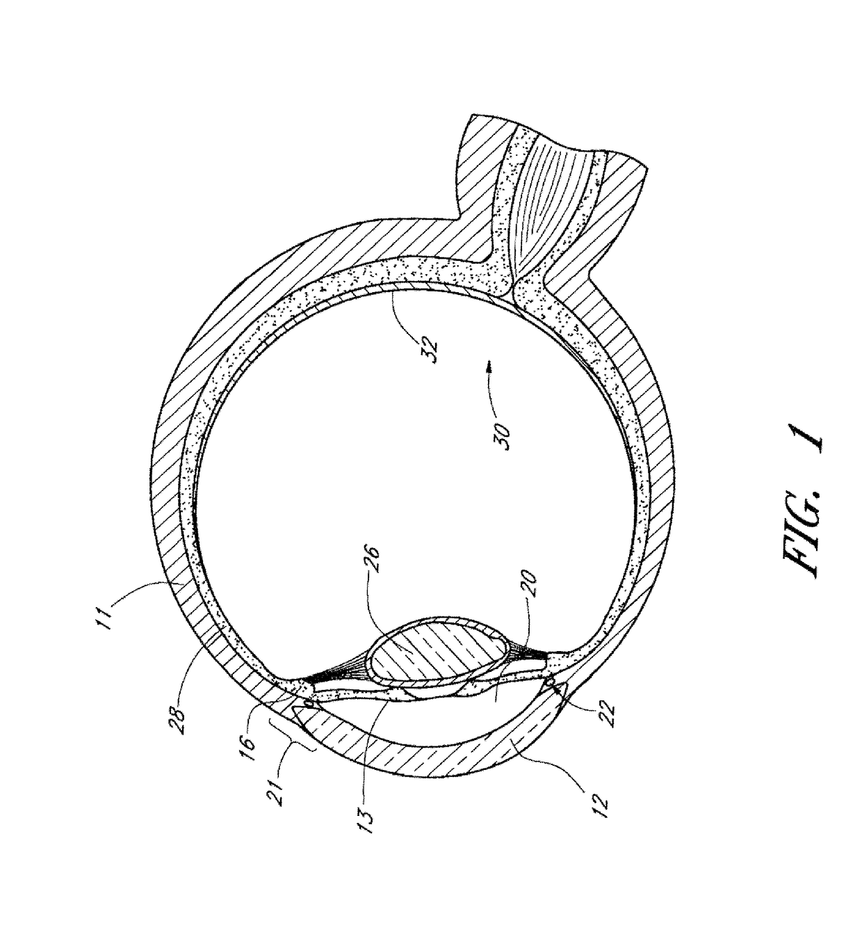 Implants with controlled drug delivery features and methods of using same